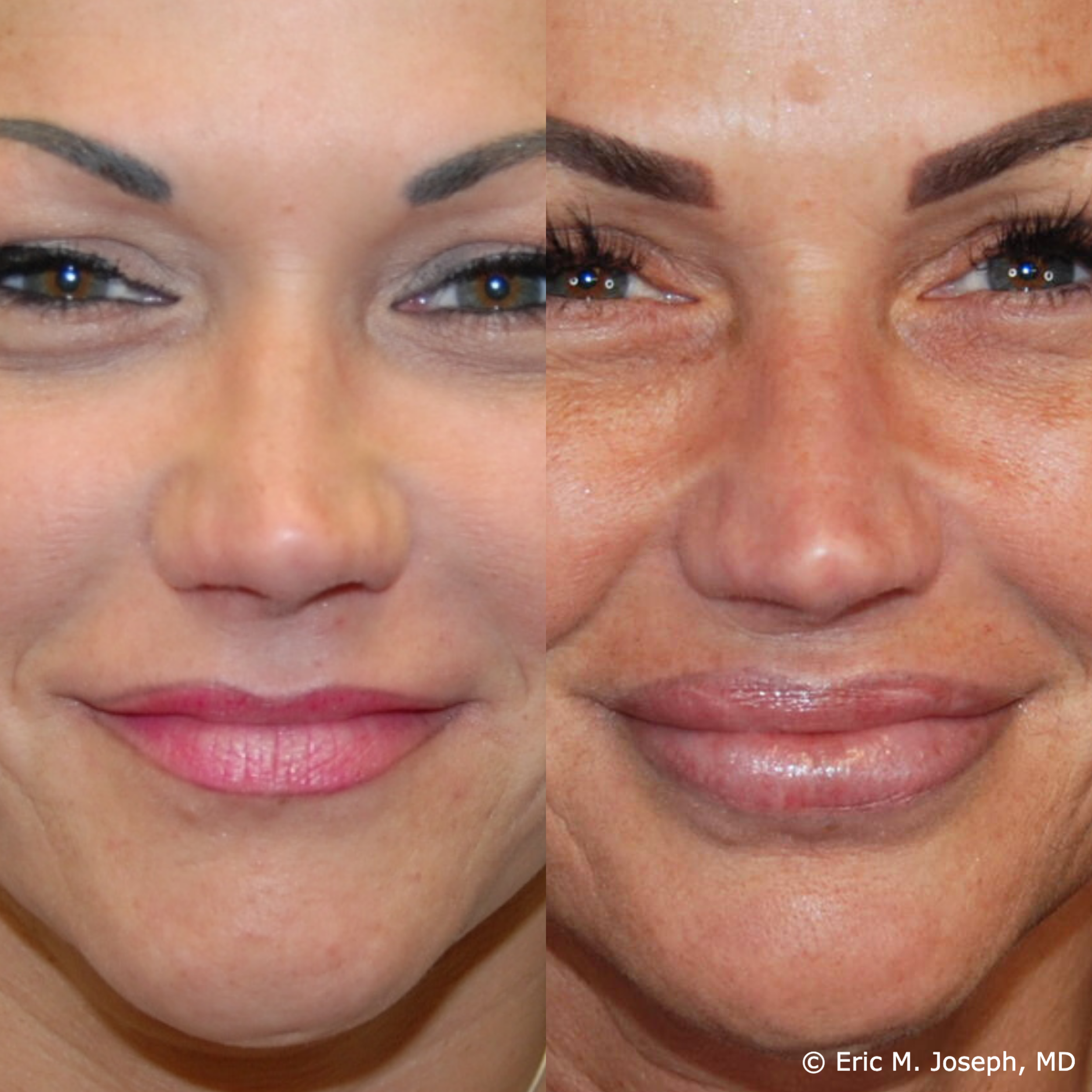 lip-augmentation-permanent-filler-nj-0095.png