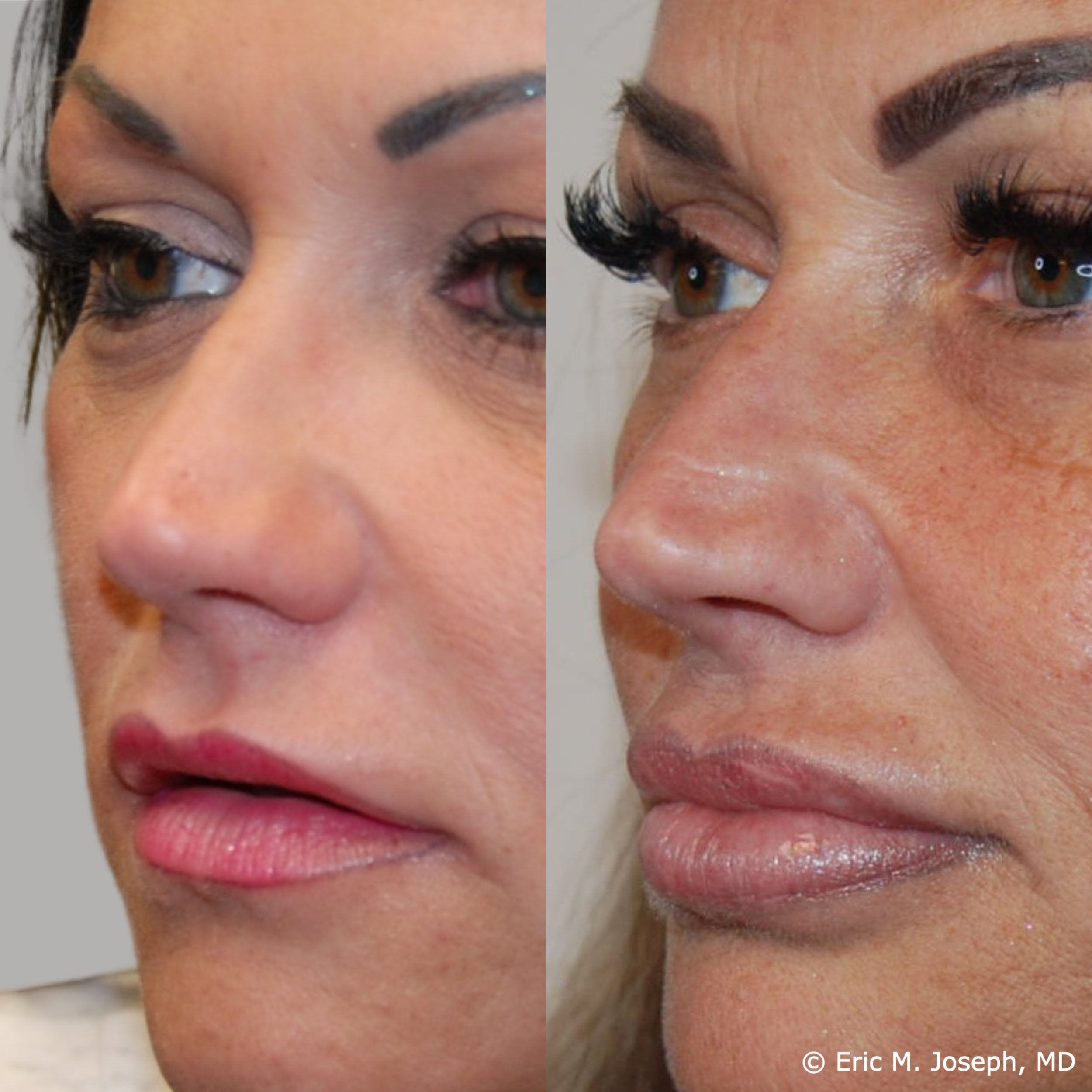 lip-augmentation-permanent-filler-nj-0094.png