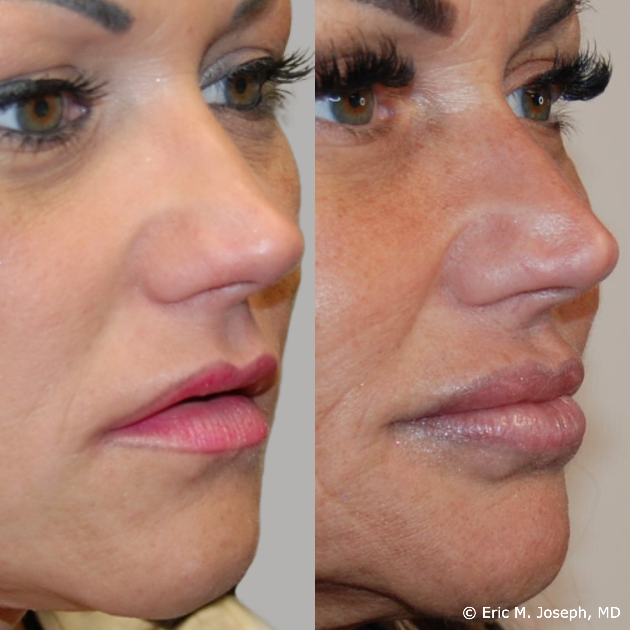 lip-augmentation-permanent-filler-nj-0093.png