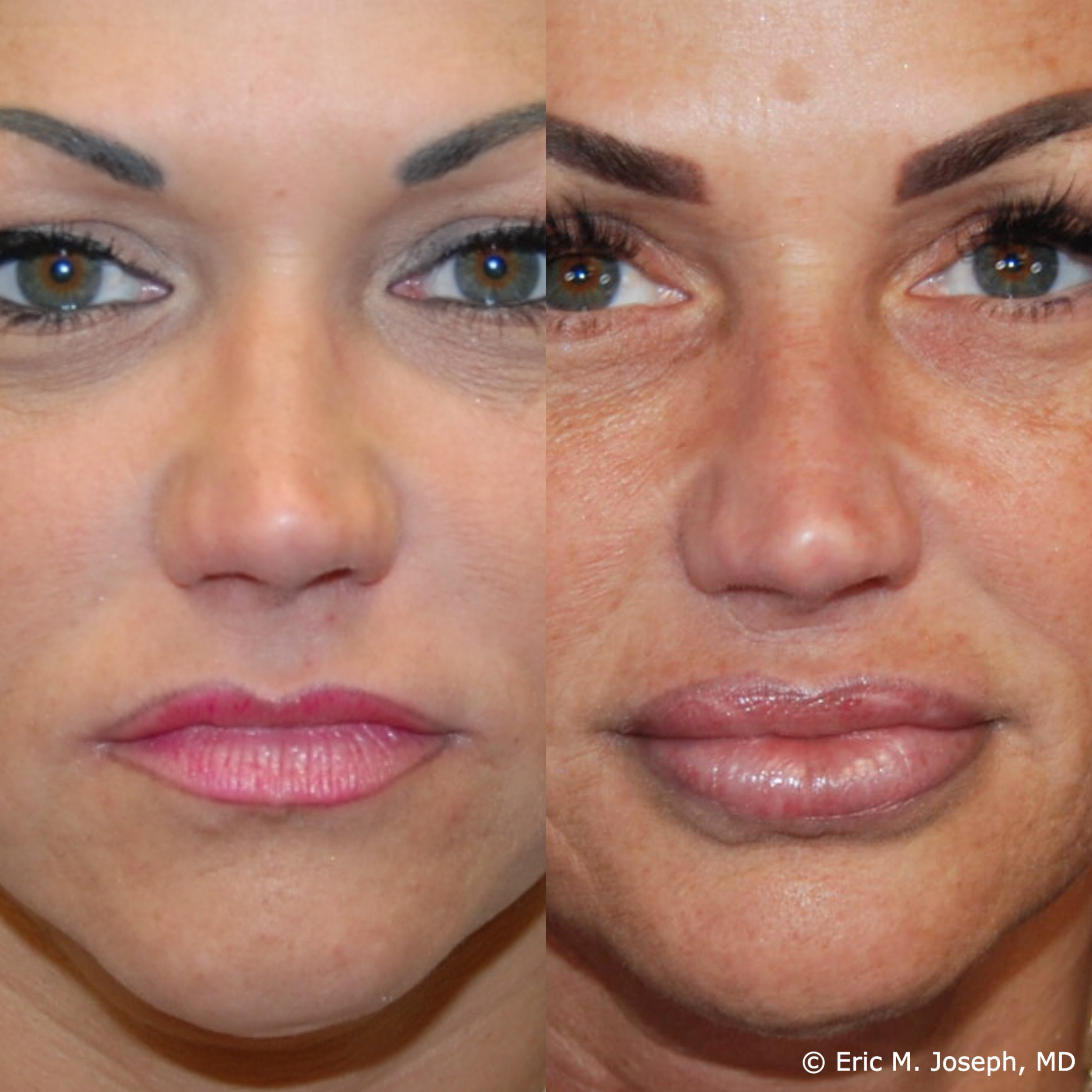 lip-augmentation-permanent-filler-nj-0096.png