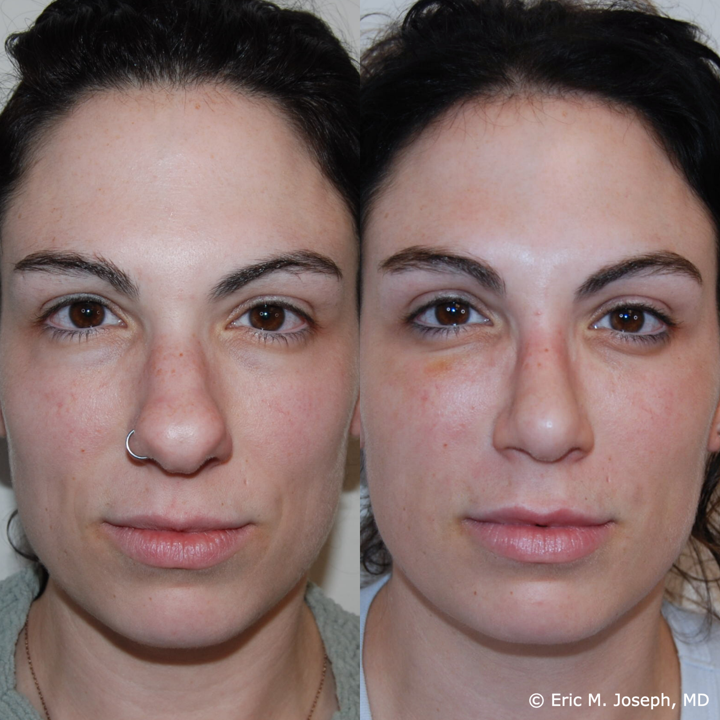 primary-rhinoplasty-nj-1504.png