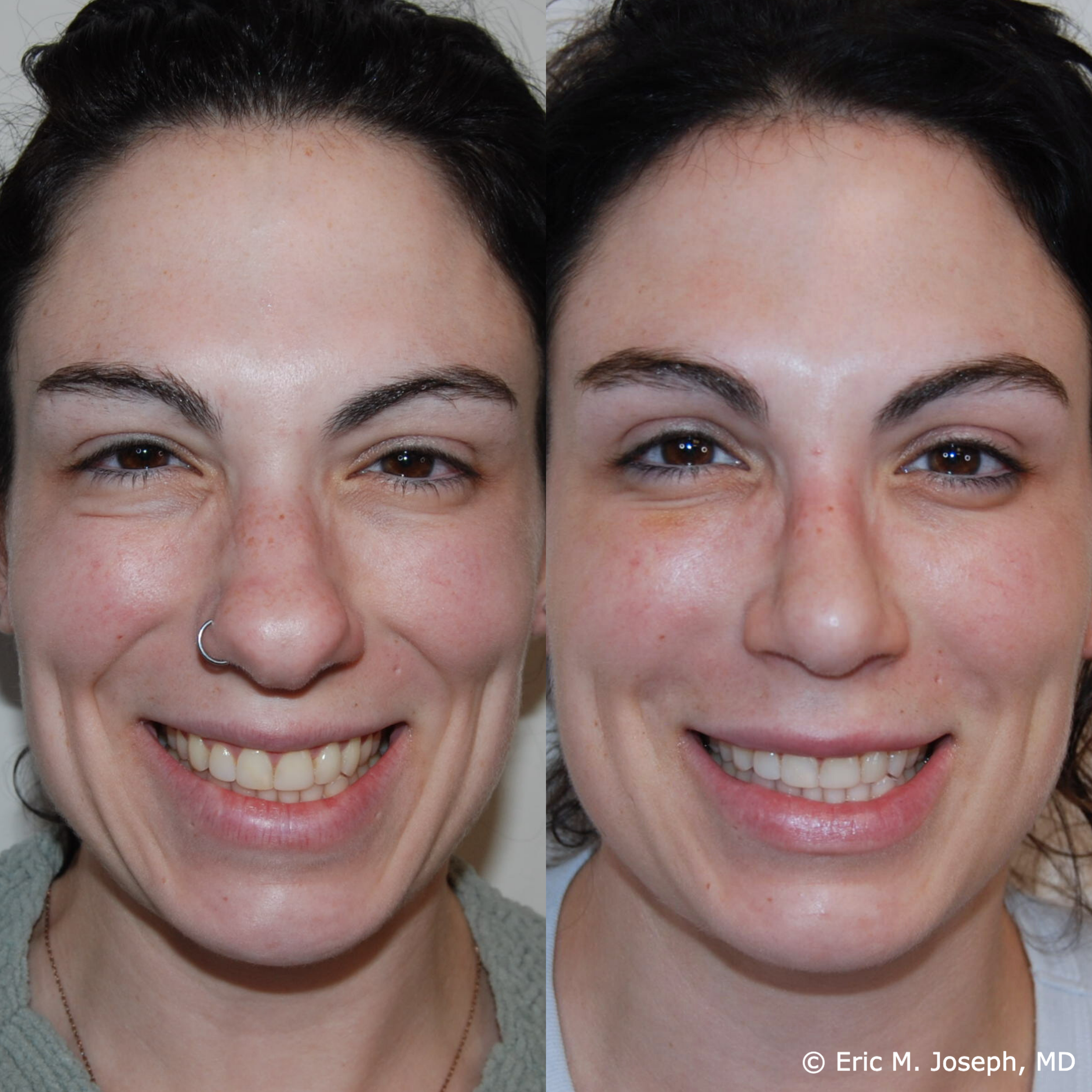 primary-rhinoplasty-nj-1505.png