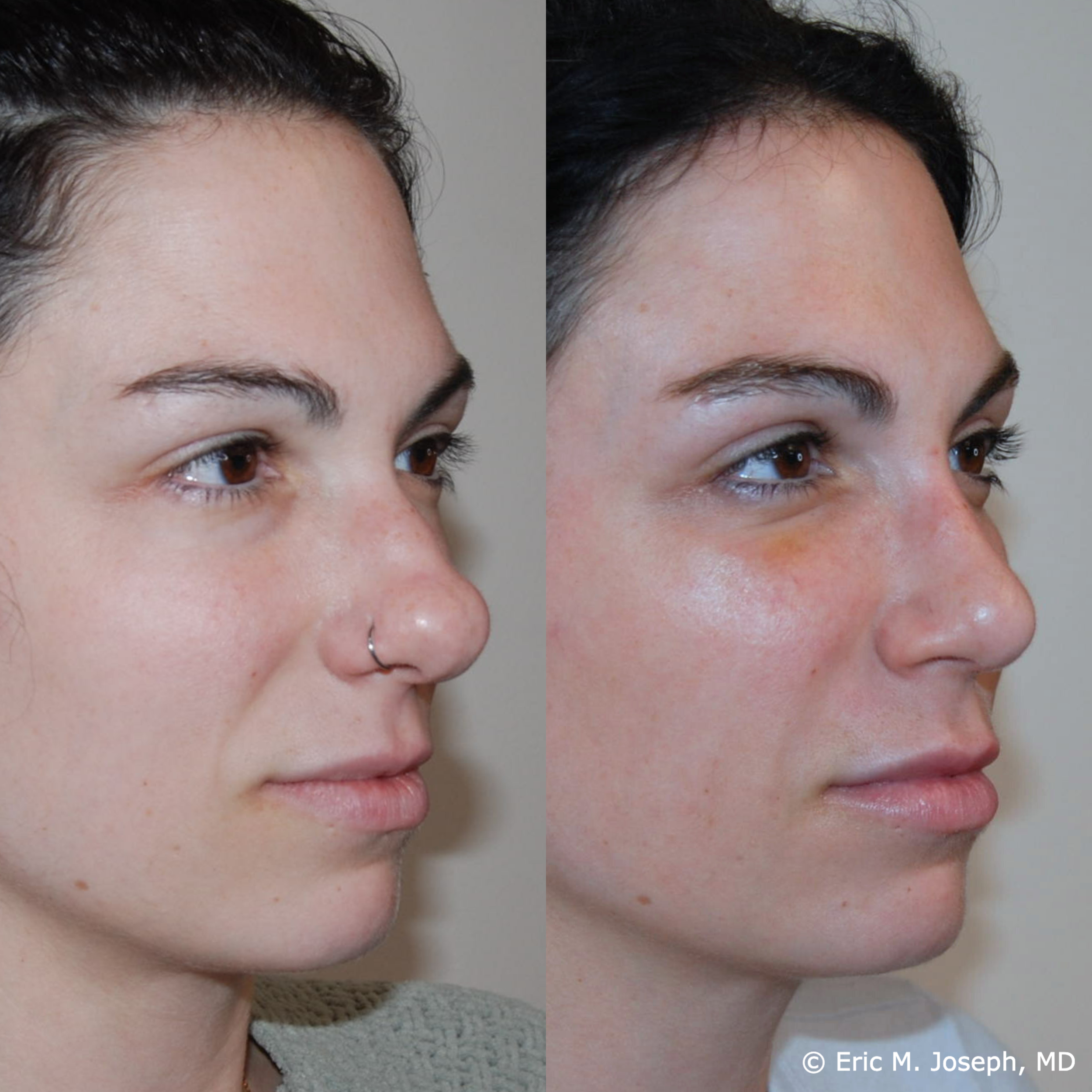 primary-rhinoplasty-nj-1506.png