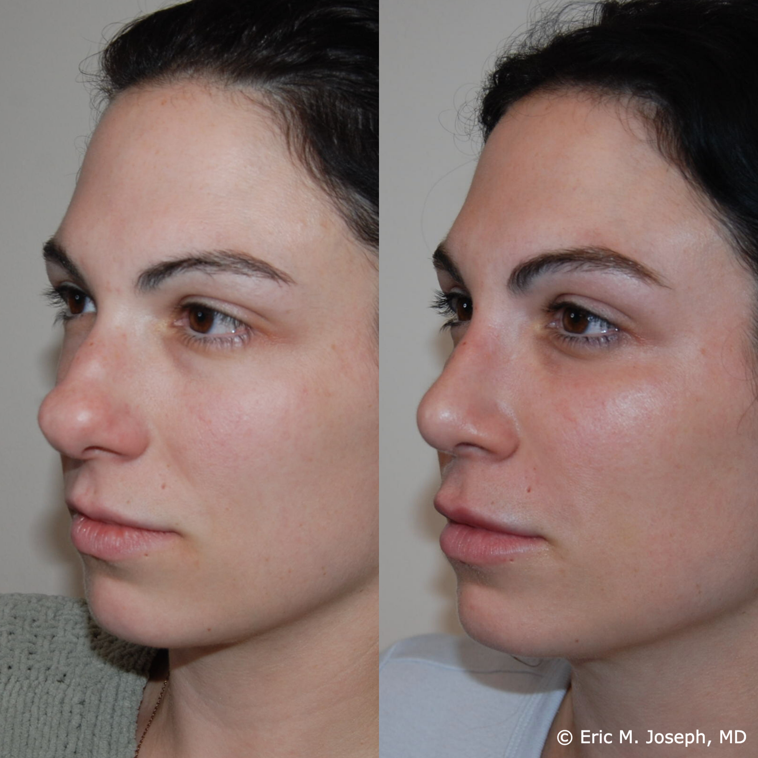 primary-rhinoplasty-nj-1507.png
