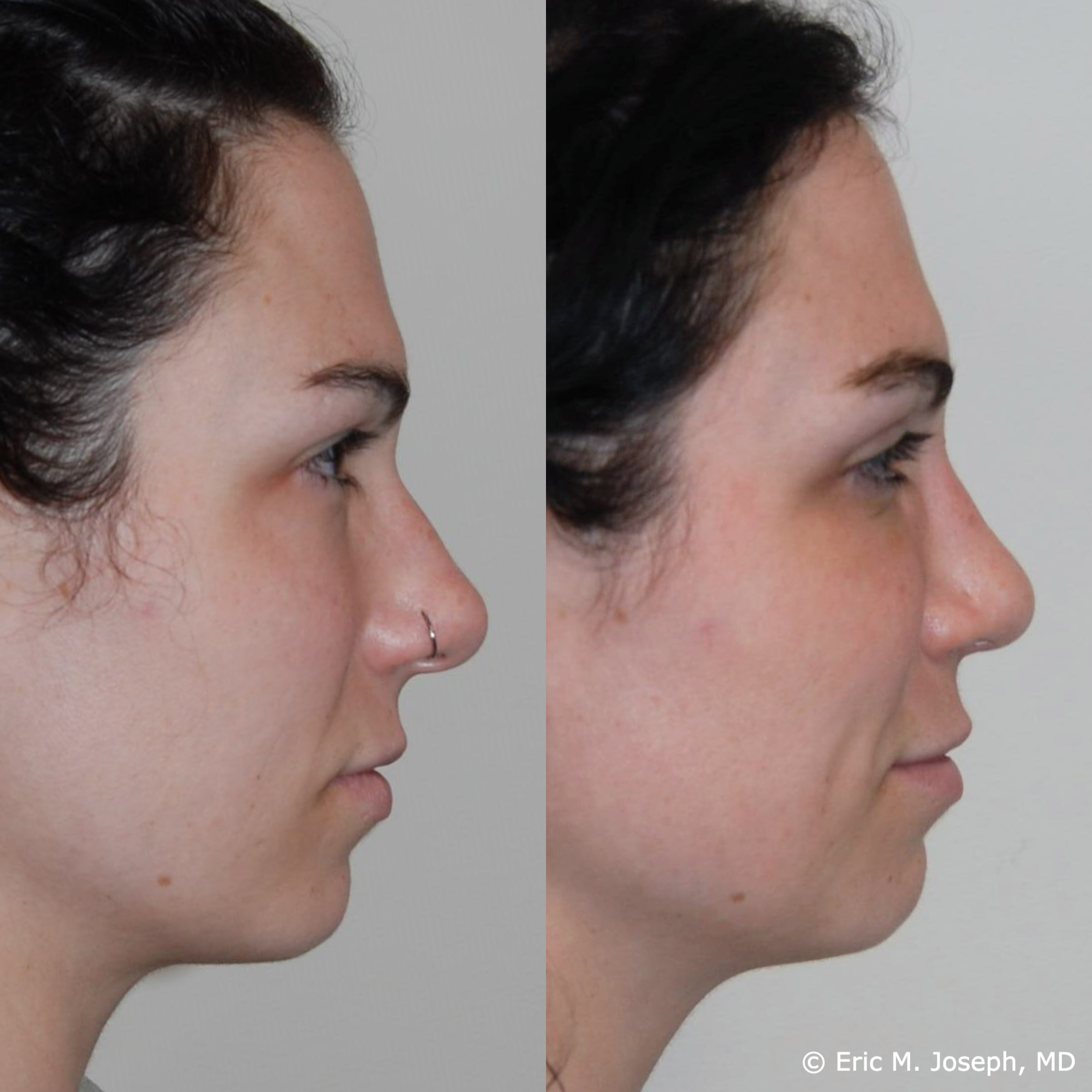 primary-rhinoplasty-nj-1508.png
