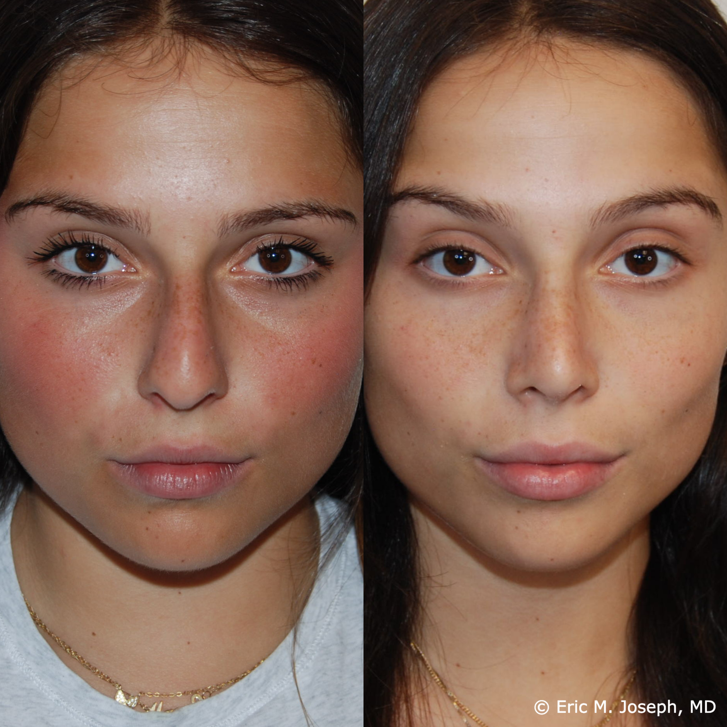 primary-rhinoplasty-nj-1511.png