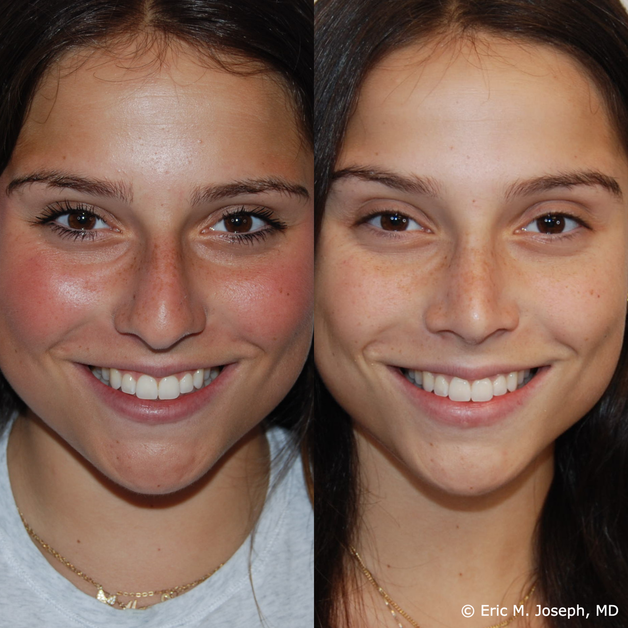 primary-rhinoplasty-nj-1510.png