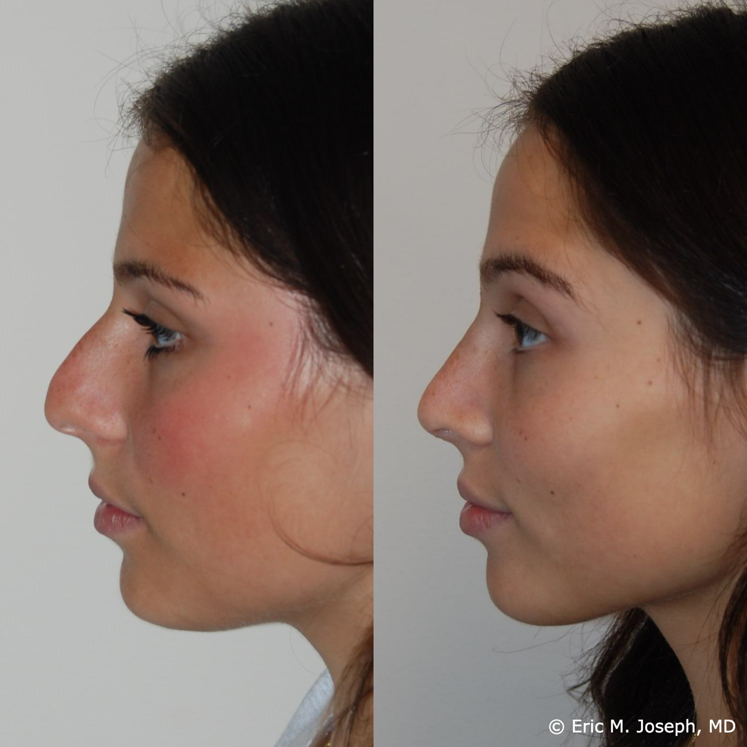 primary-rhinoplasty-nj-1514.png