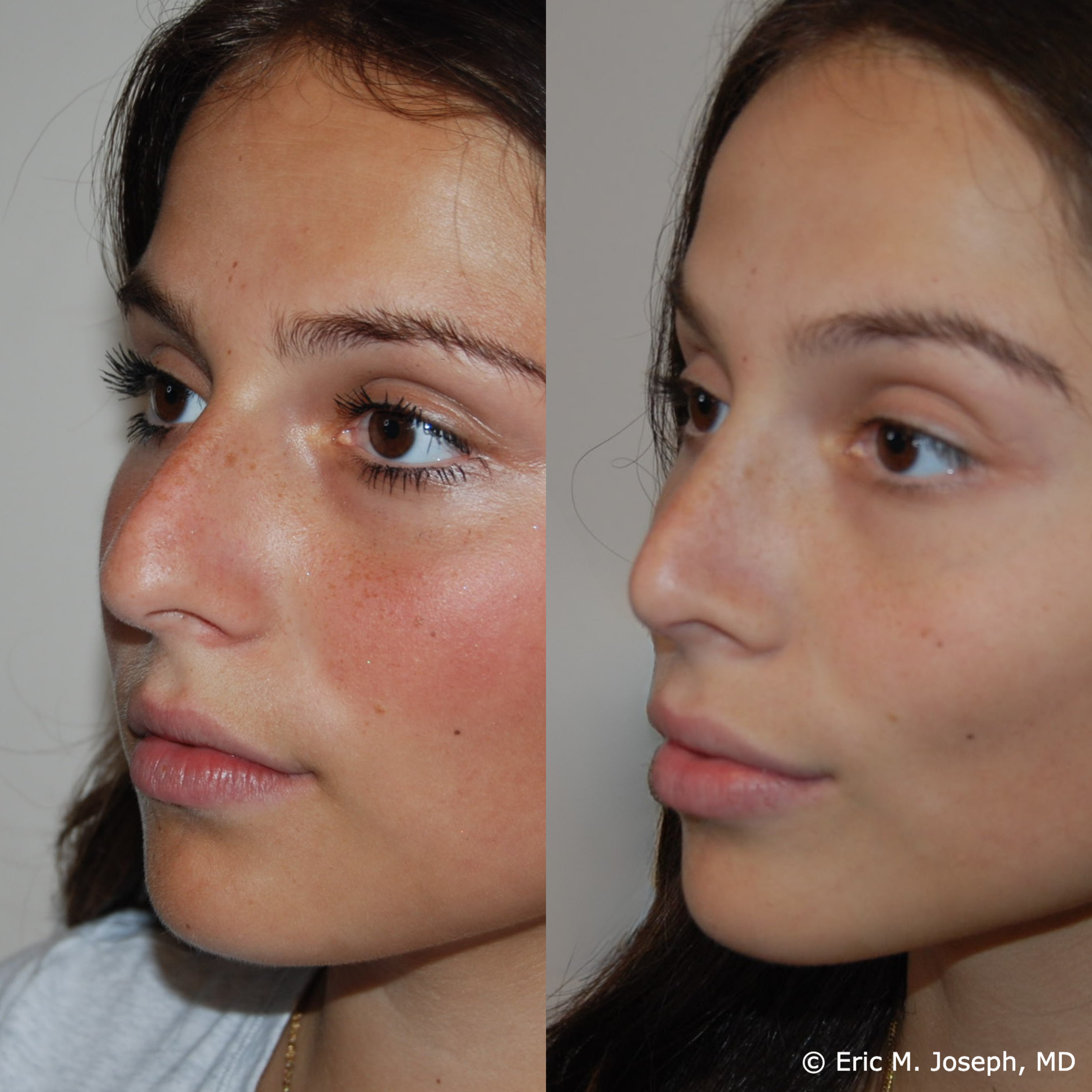 primary-rhinoplasty-nj-1515.png