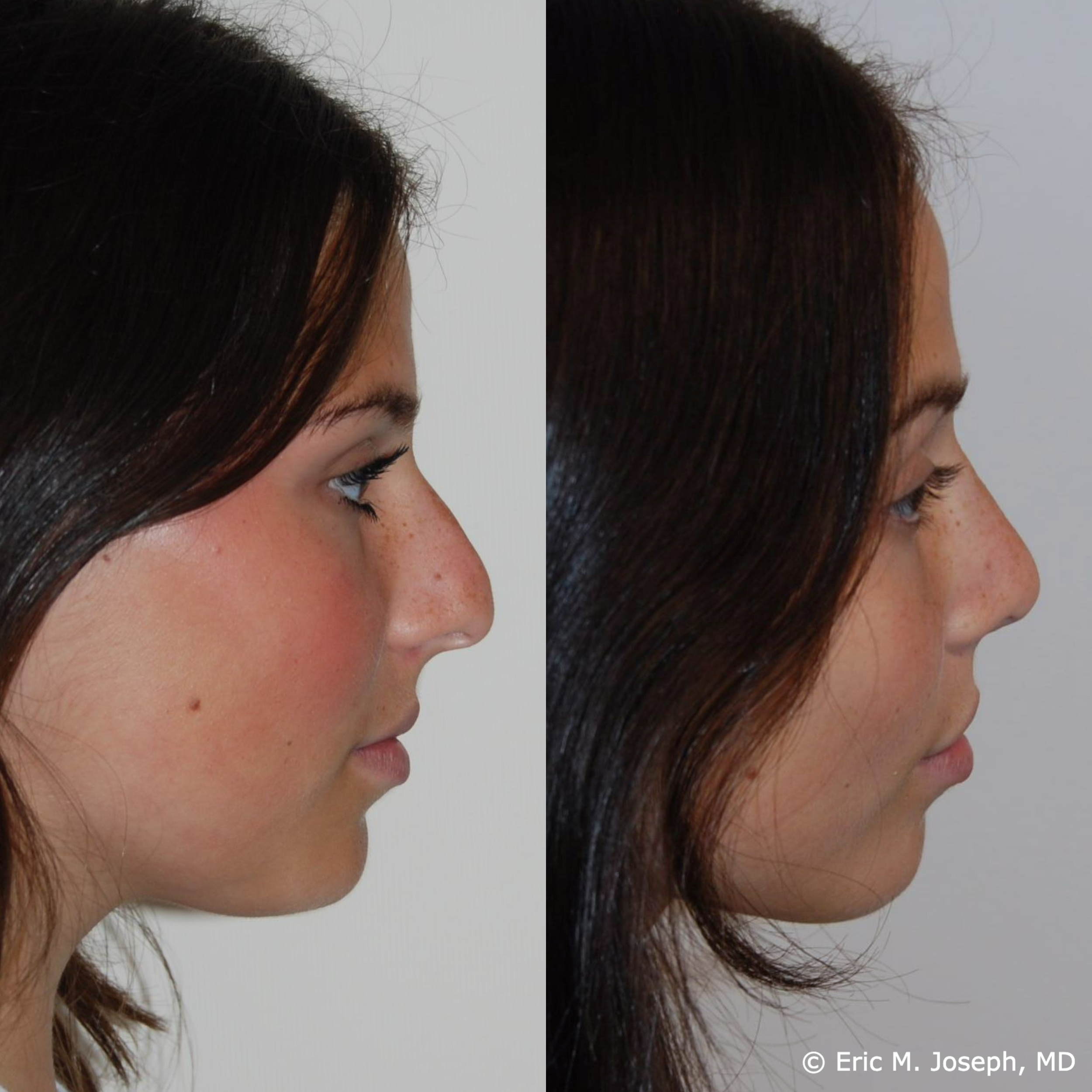 primary-rhinoplasty-nj-1516.png