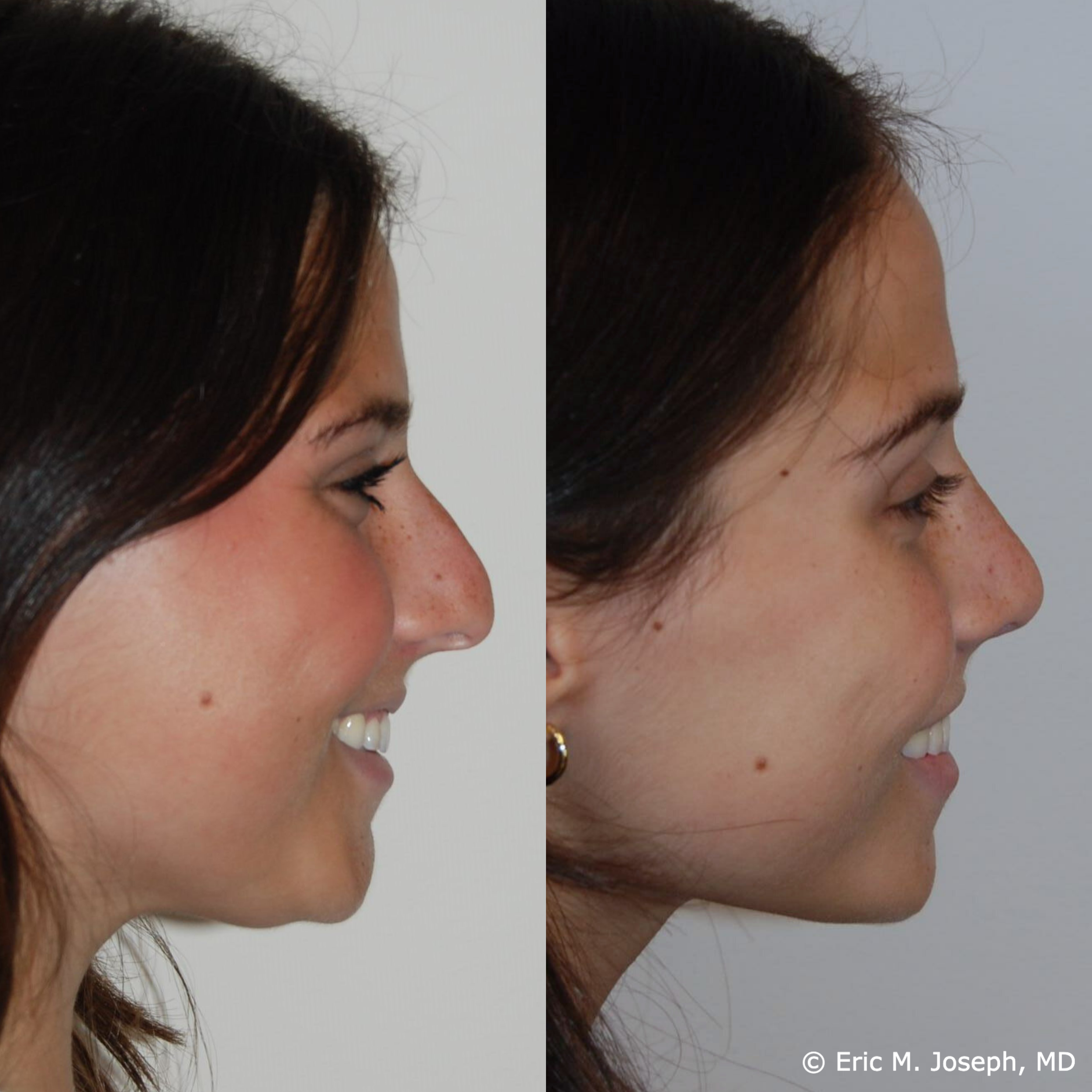 primary-rhinoplasty-nj-1517.png
