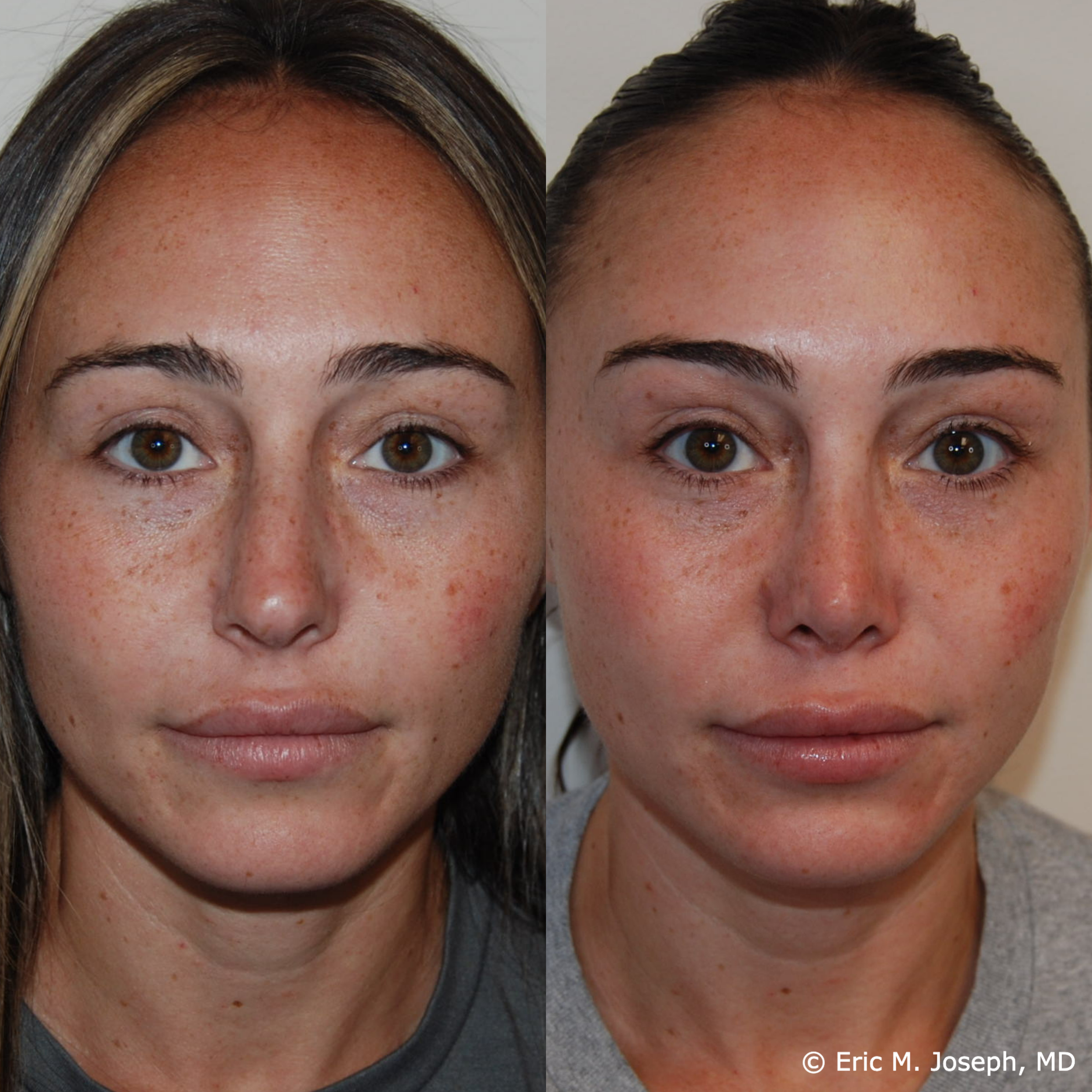 primary-rhinoplasty-nj-1518.png