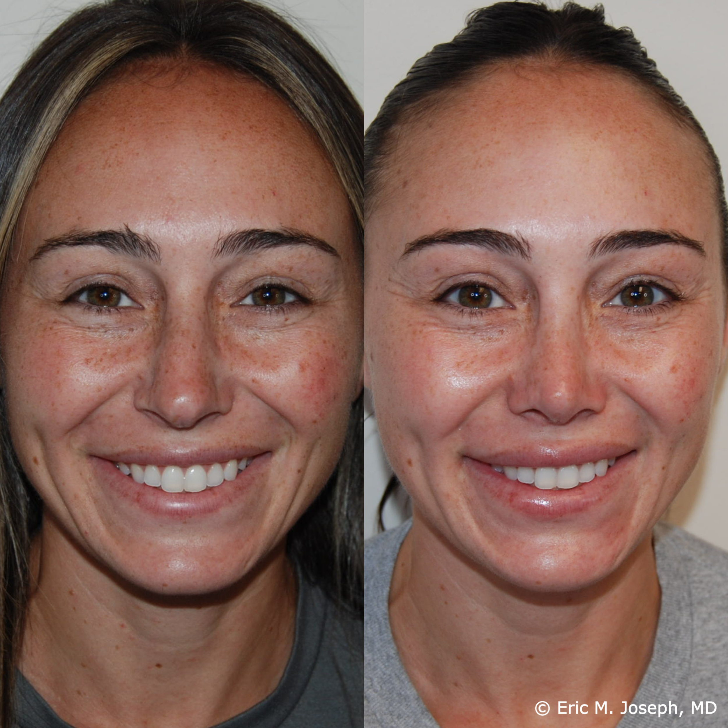 primary-rhinoplasty-nj-1519.png