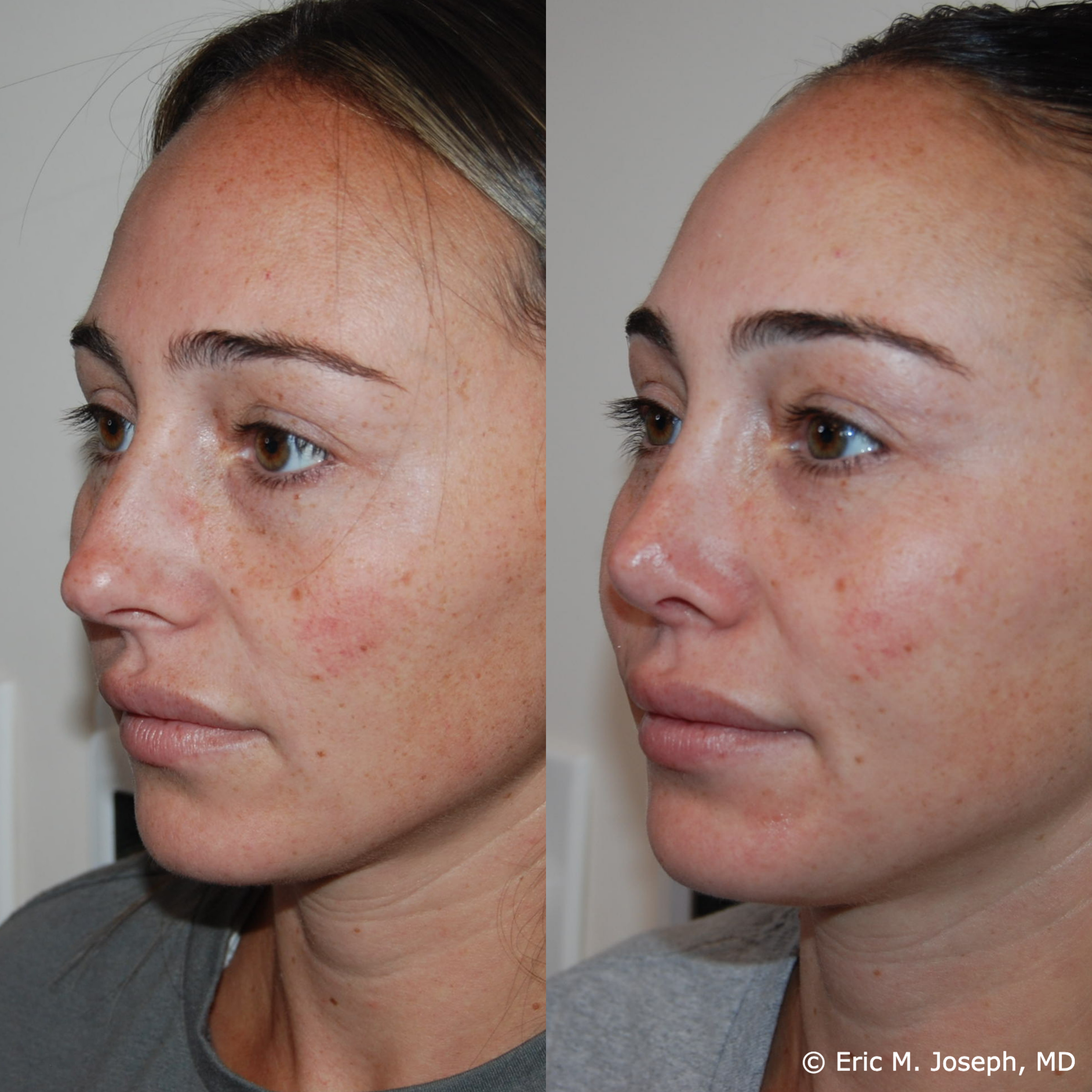 primary-rhinoplasty-nj-1521.png