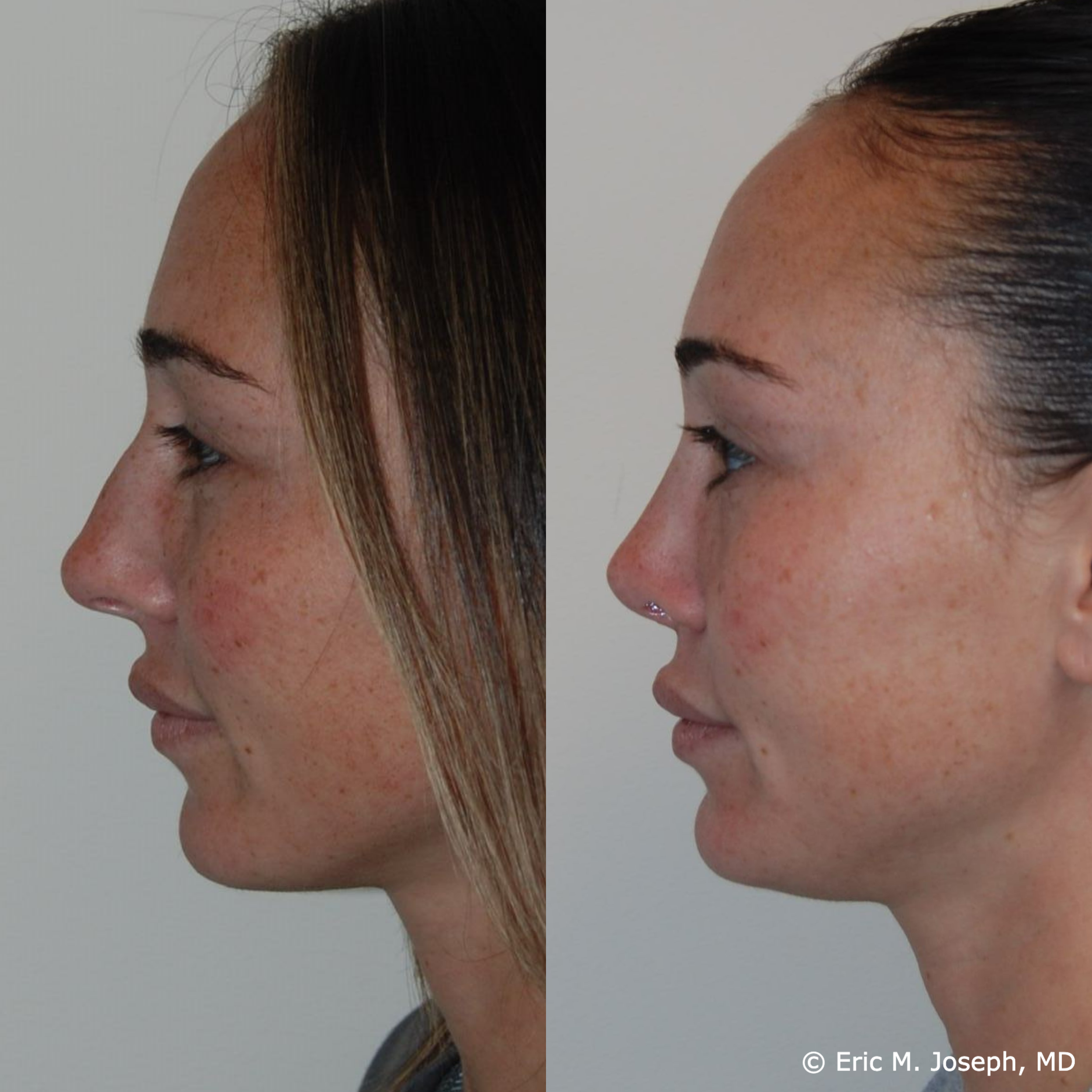 primary-rhinoplasty-nj-1522.png