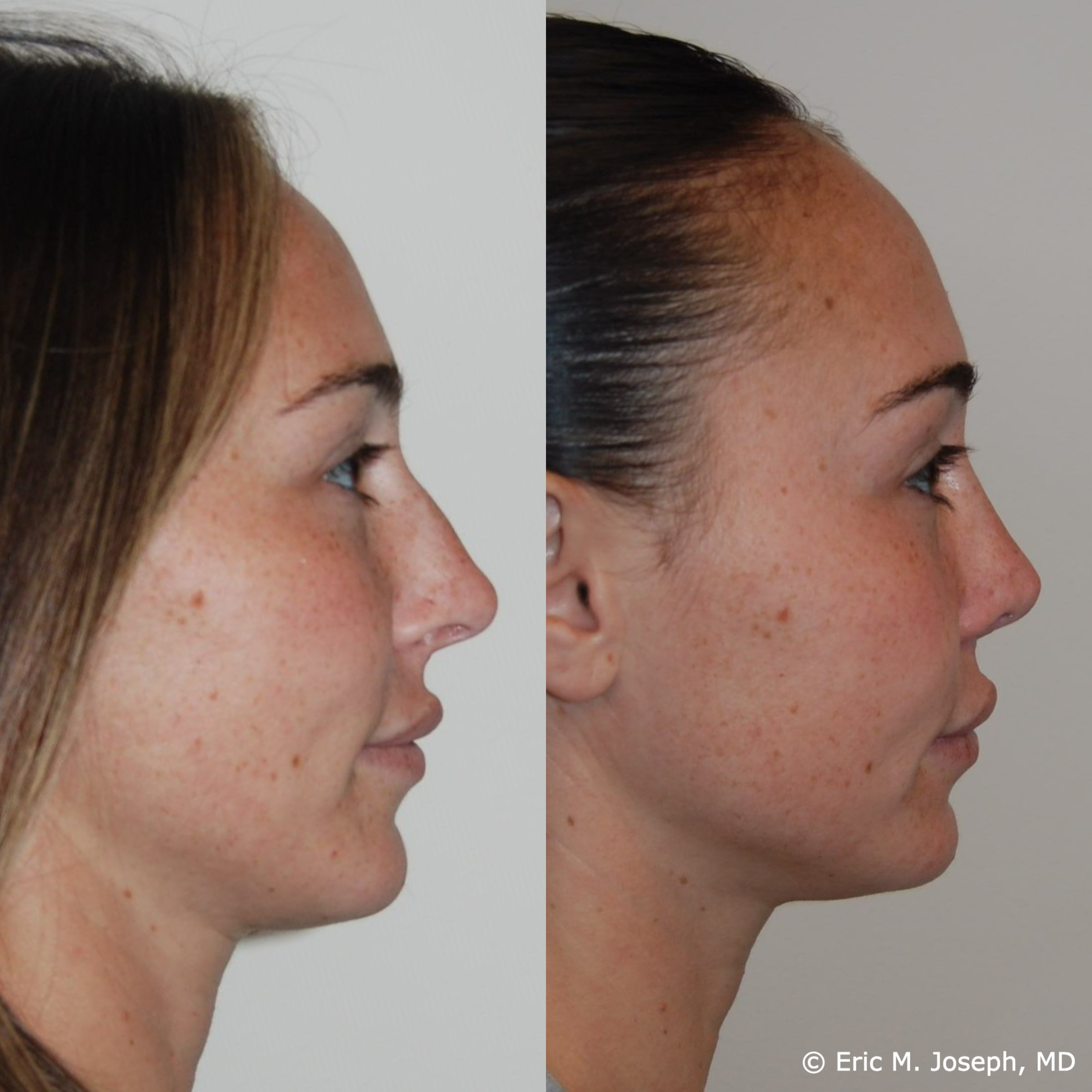 primary-rhinoplasty-nj-1523.png