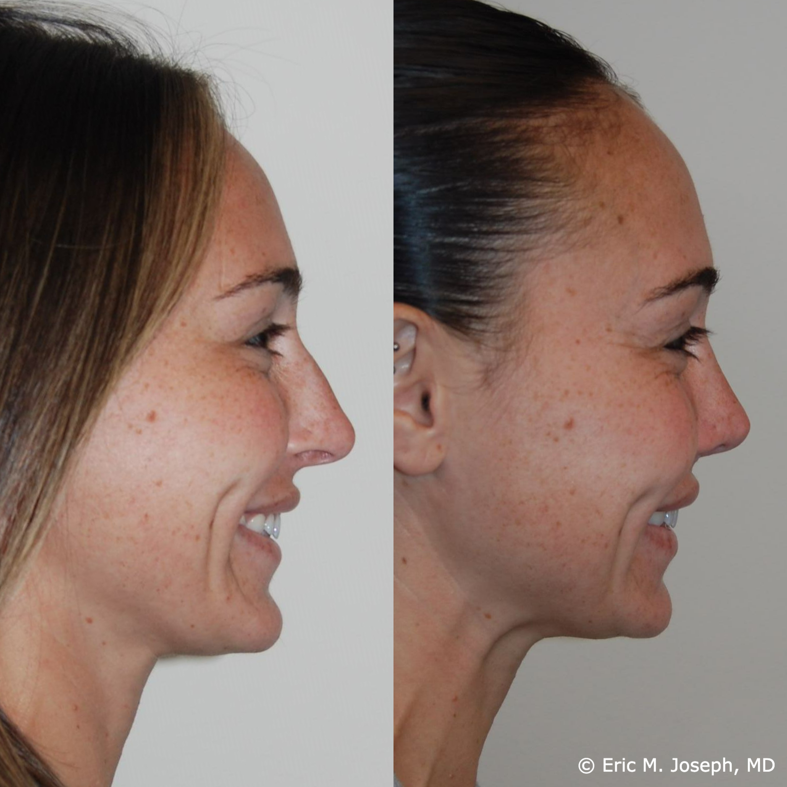 primary-rhinoplasty-nj-1524.png