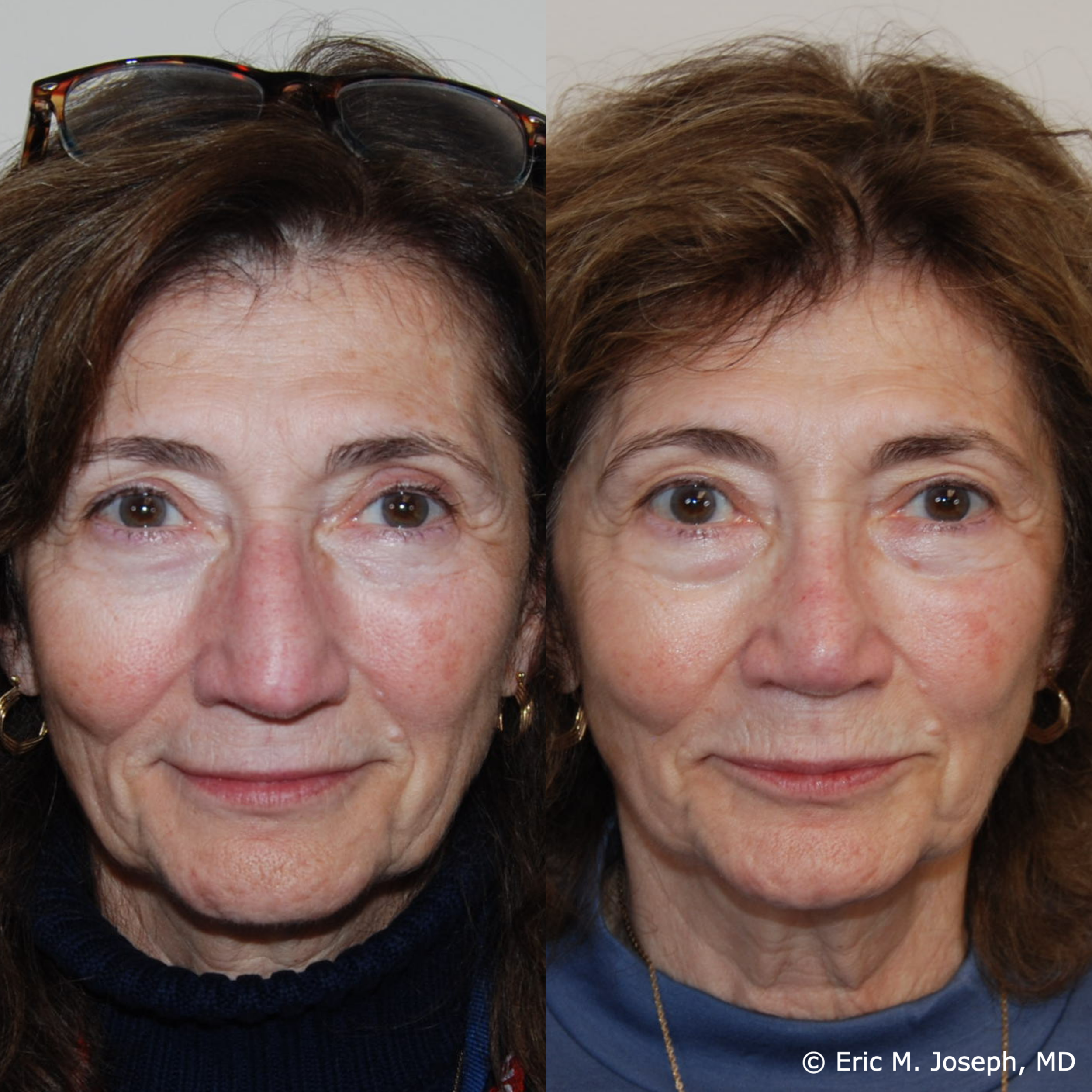 primary-rhinoplasty-nj-1526.png
