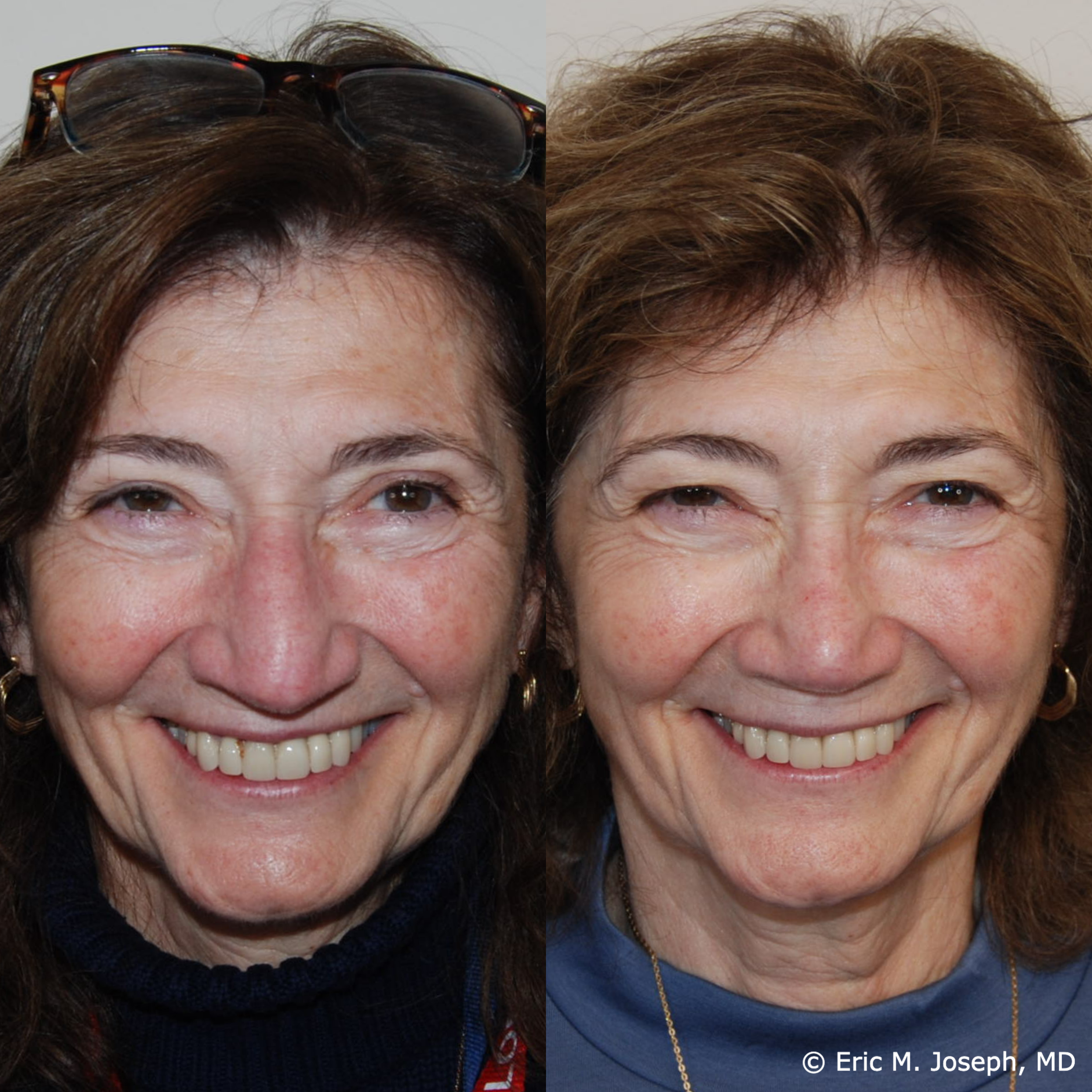 primary-rhinoplasty-nj-1525.png