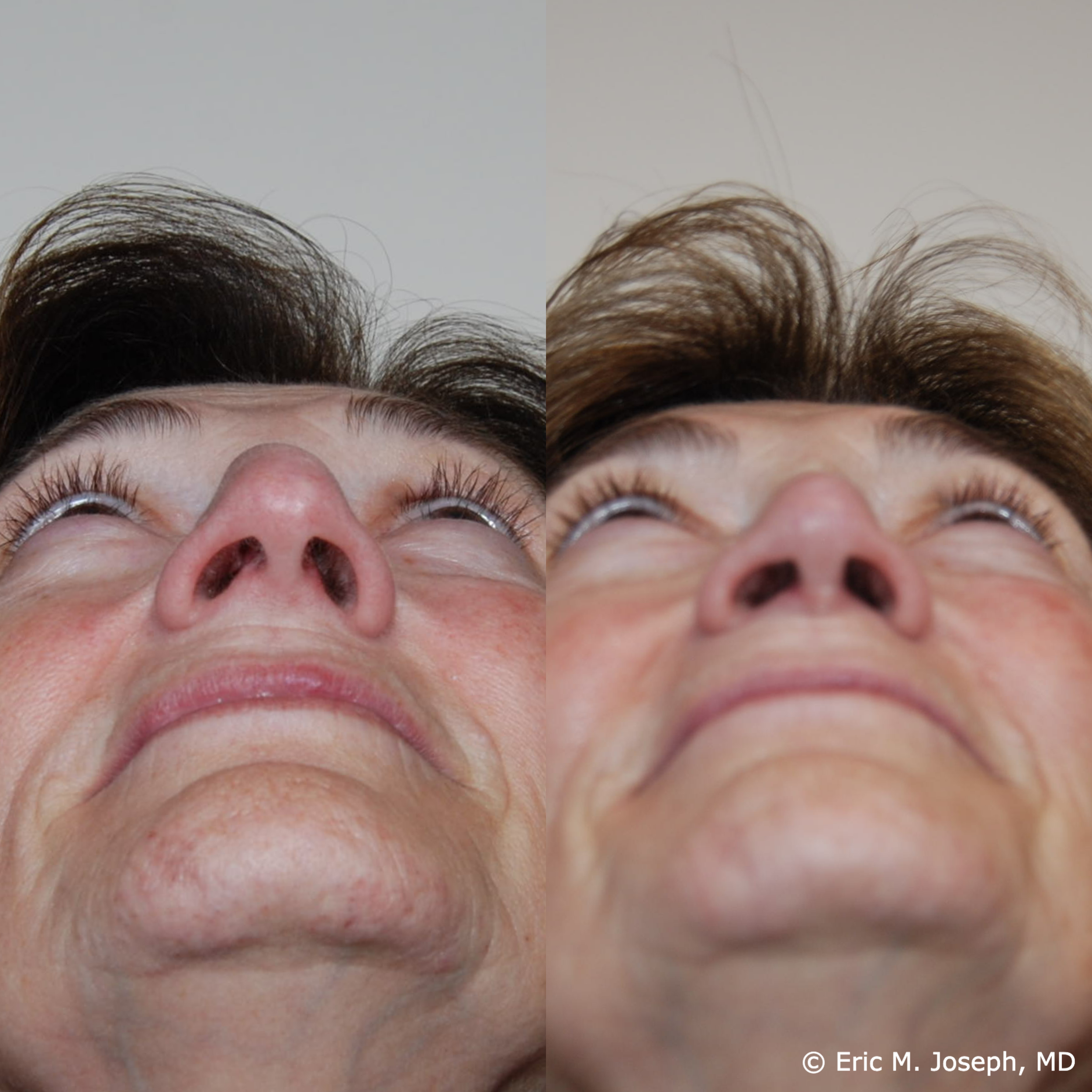 primary-rhinoplasty-nj-1527.png