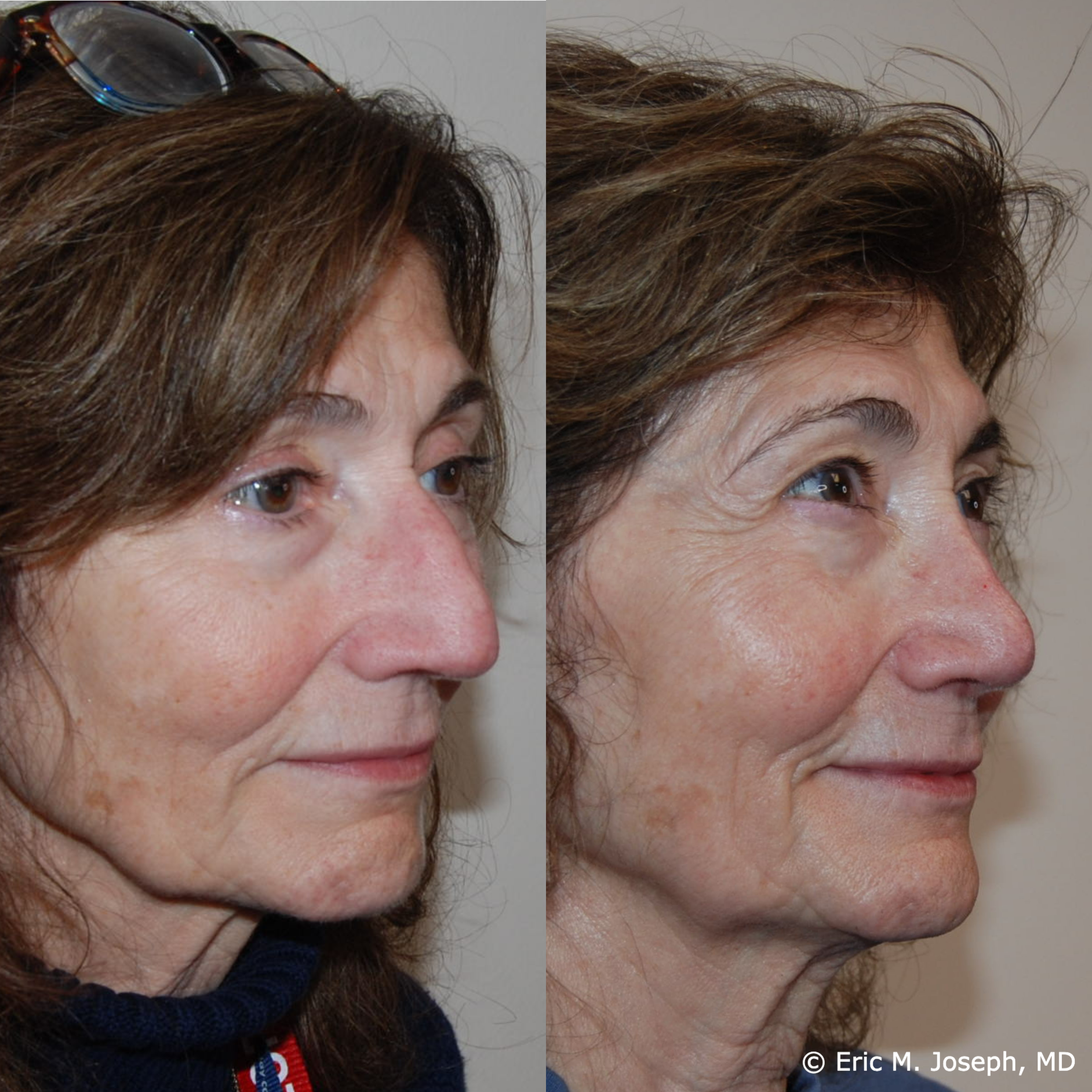 primary-rhinoplasty-nj-1528.png