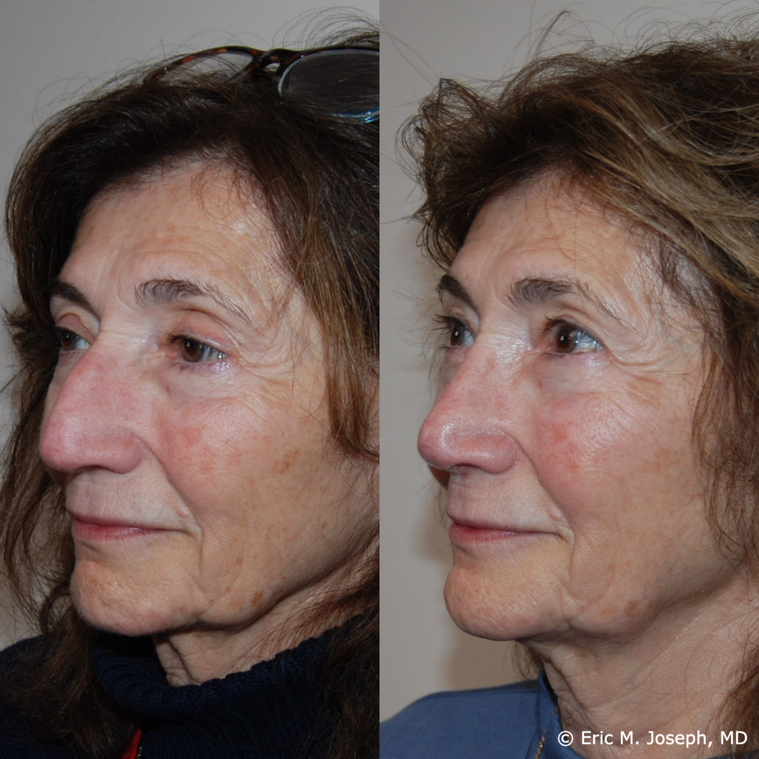 primary-rhinoplasty-nj-1529.png
