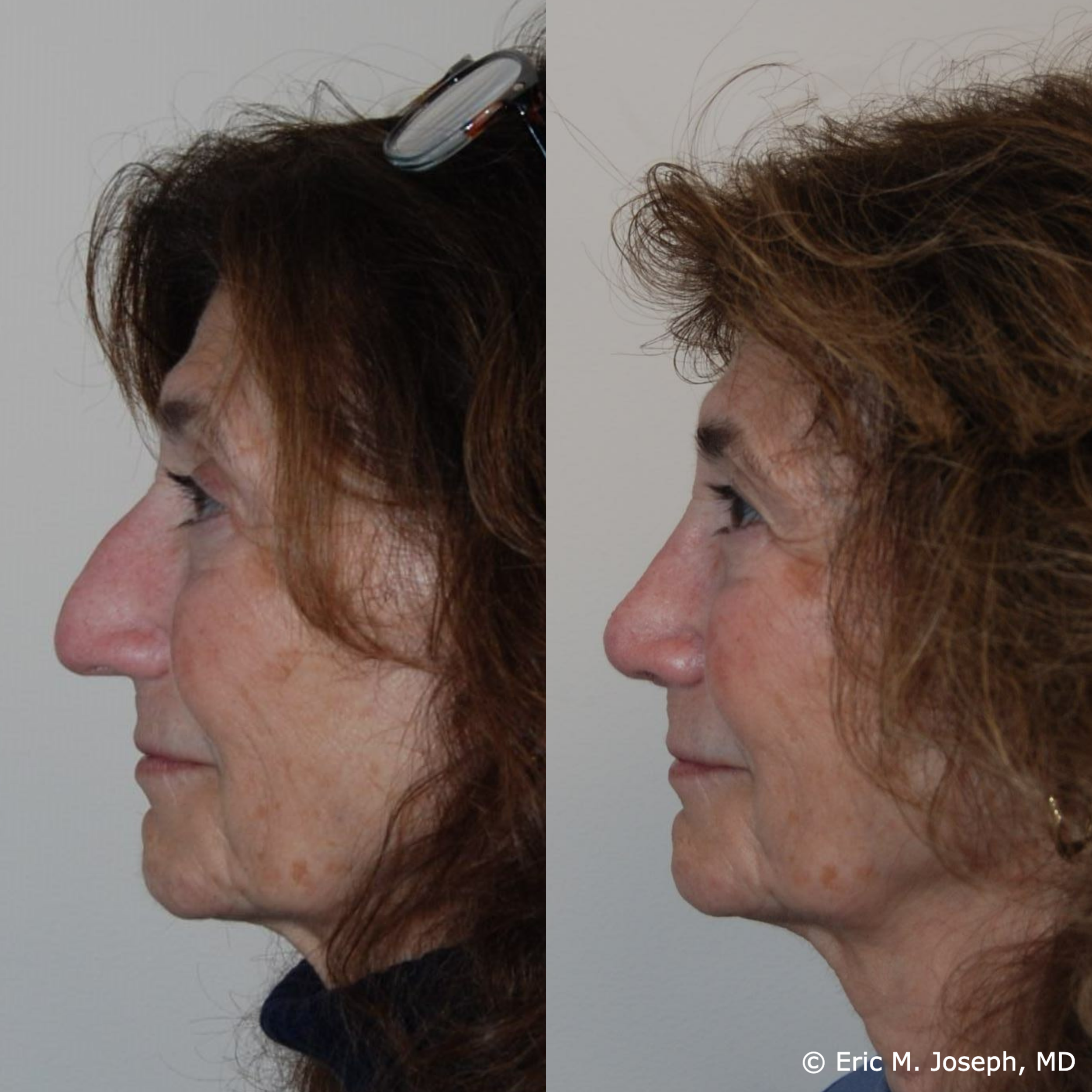 primary-rhinoplasty-nj-1530.png