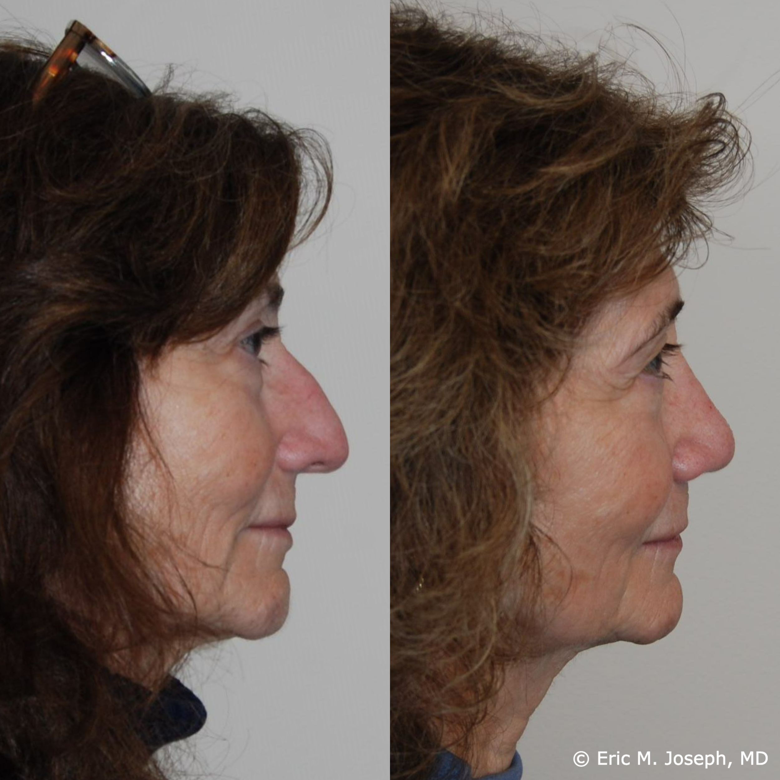 primary-rhinoplasty-nj-1531.png