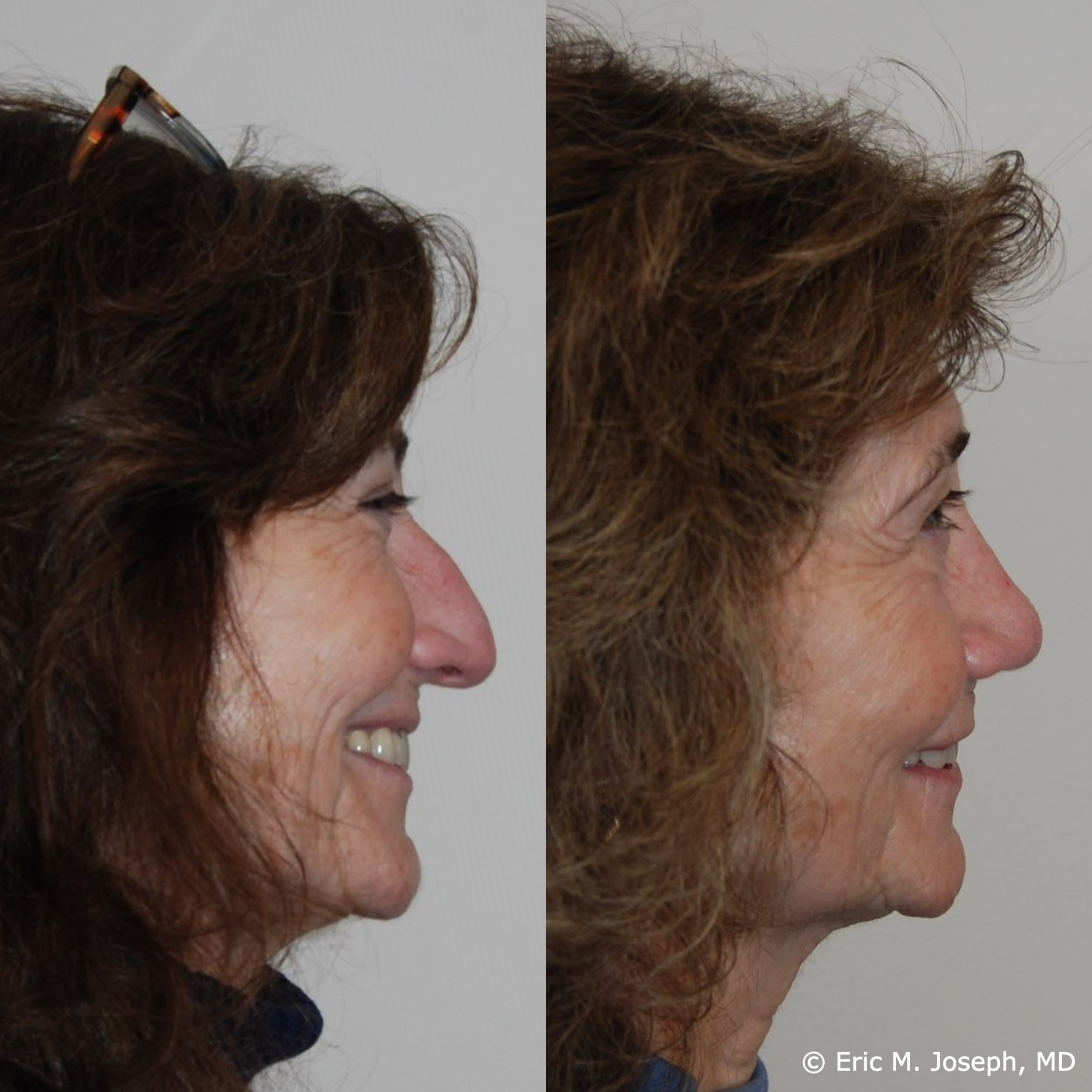 primary-rhinoplasty-nj-1532.png
