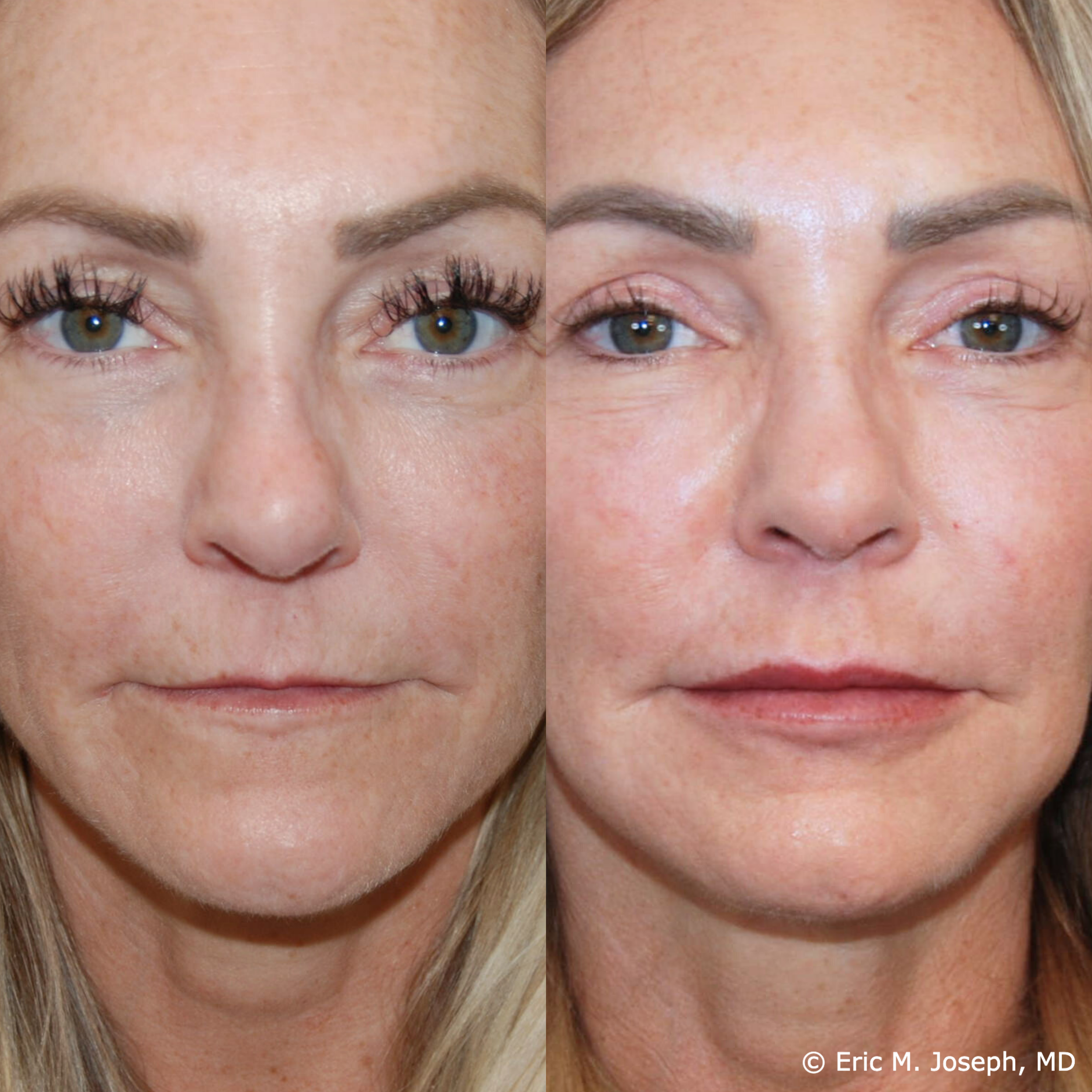 lip-augmentation-permanent-filler-nj-0098.png