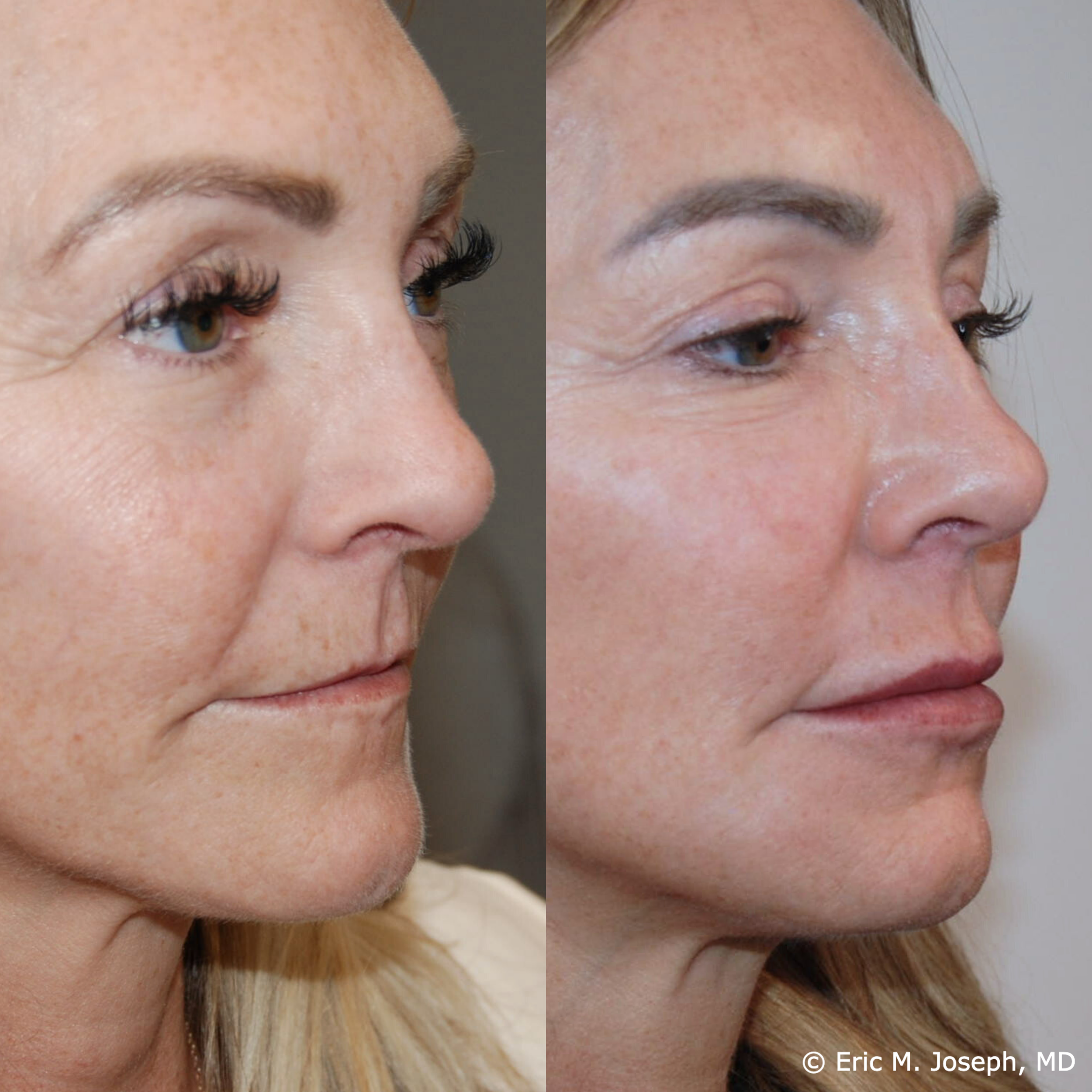 lip-augmentation-permanent-filler-nj-0099.png