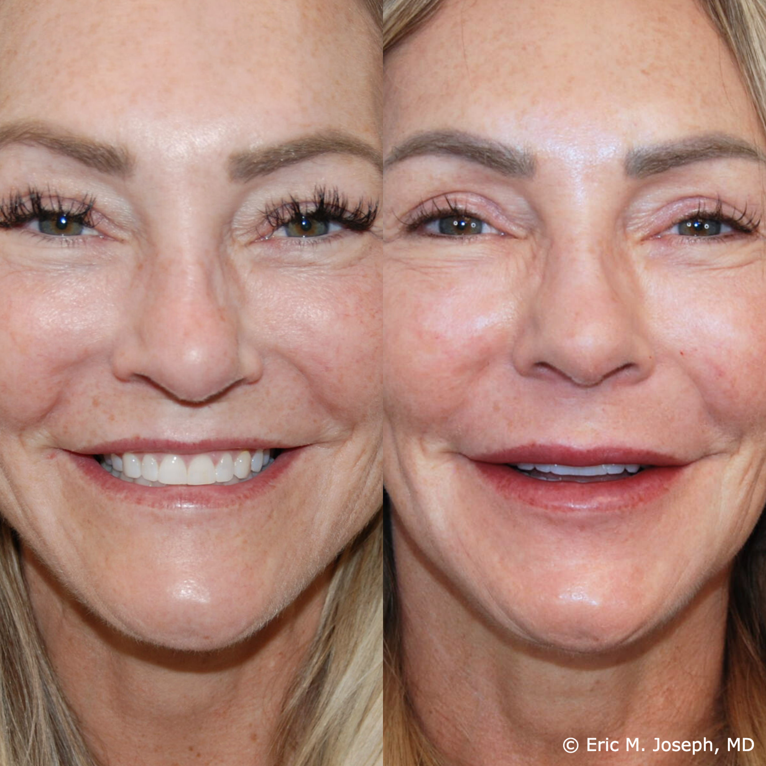 lip-augmentation-permanent-filler-nj-0097.png
