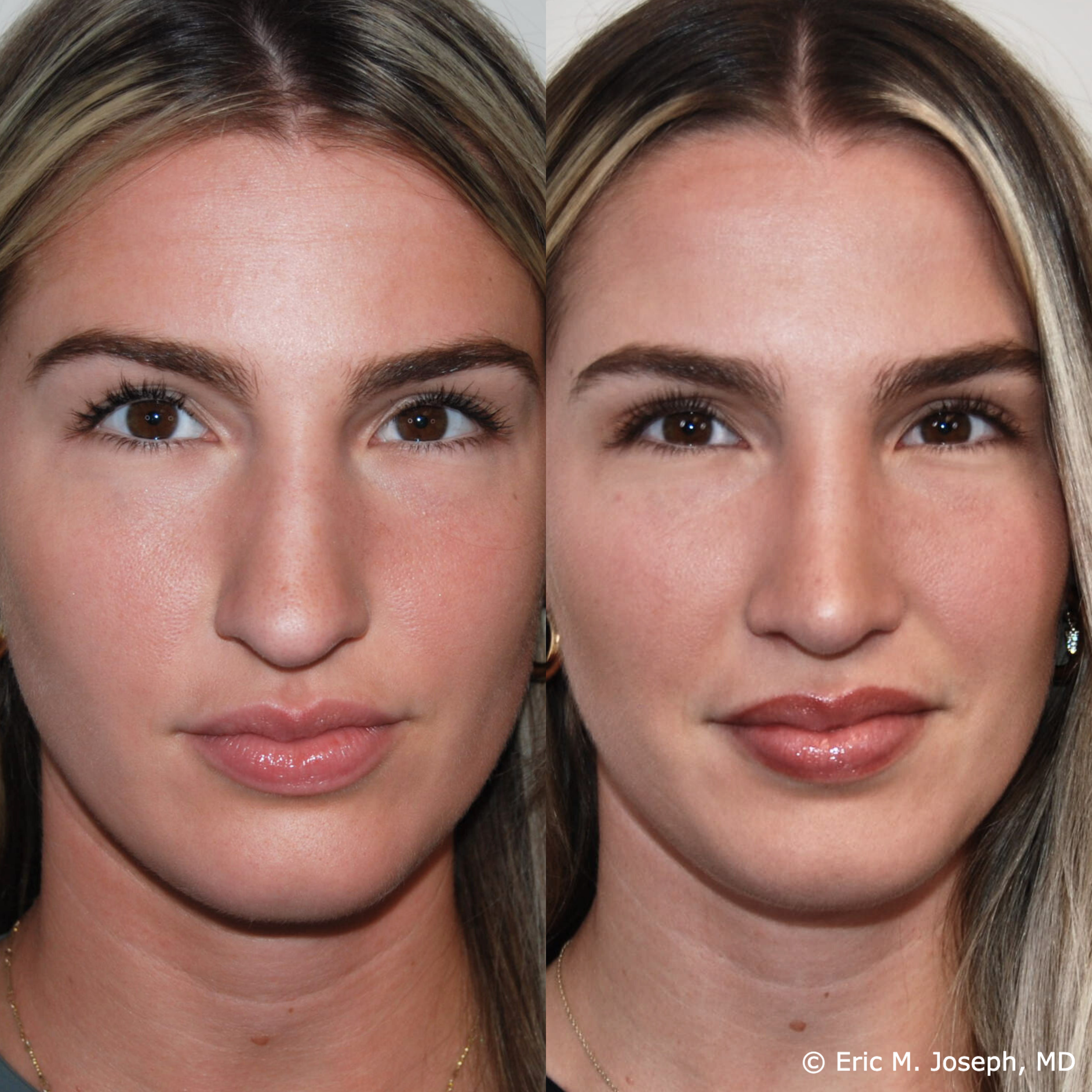 primary-rhinoplasty-nj-1534.png