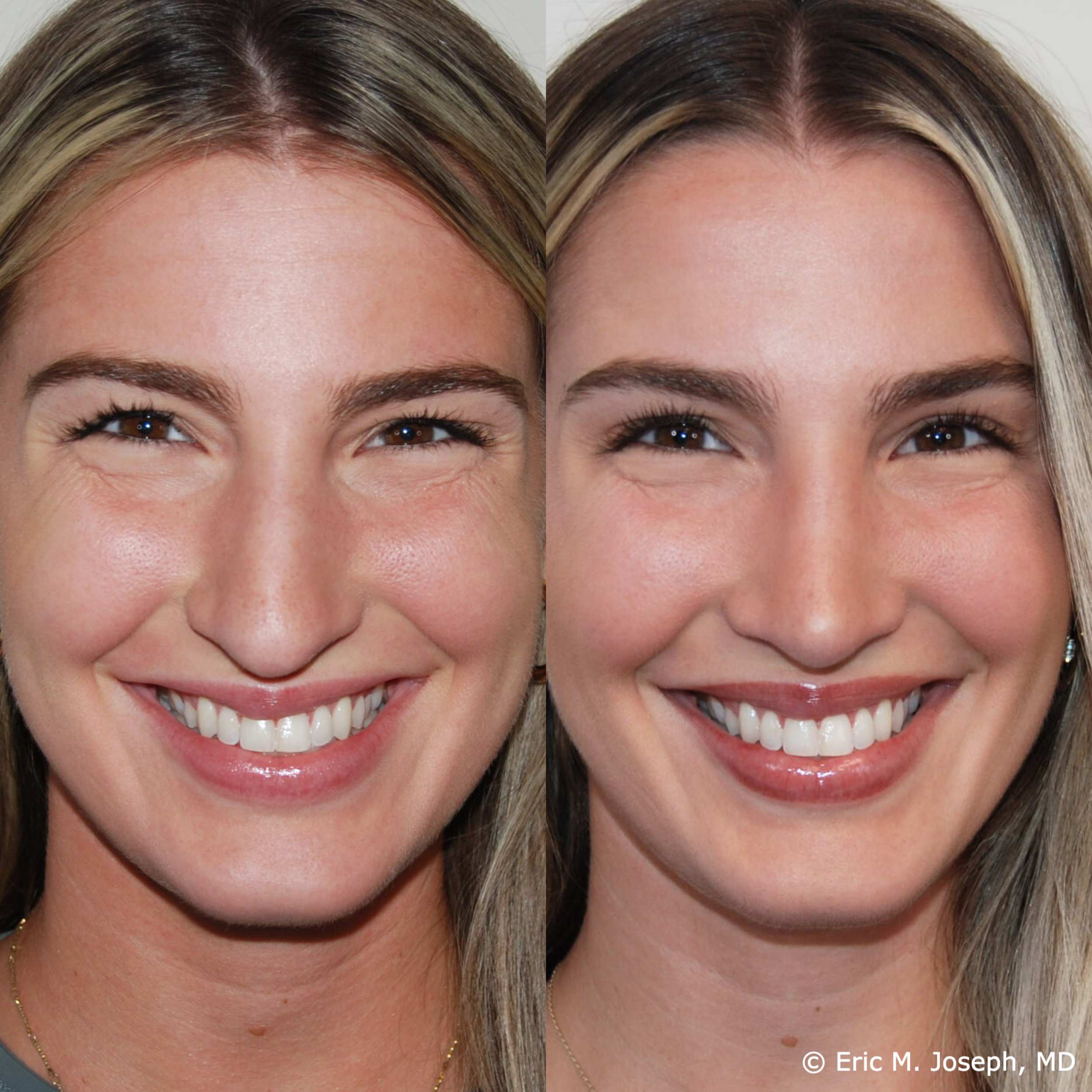 primary-rhinoplasty-nj-1533.png