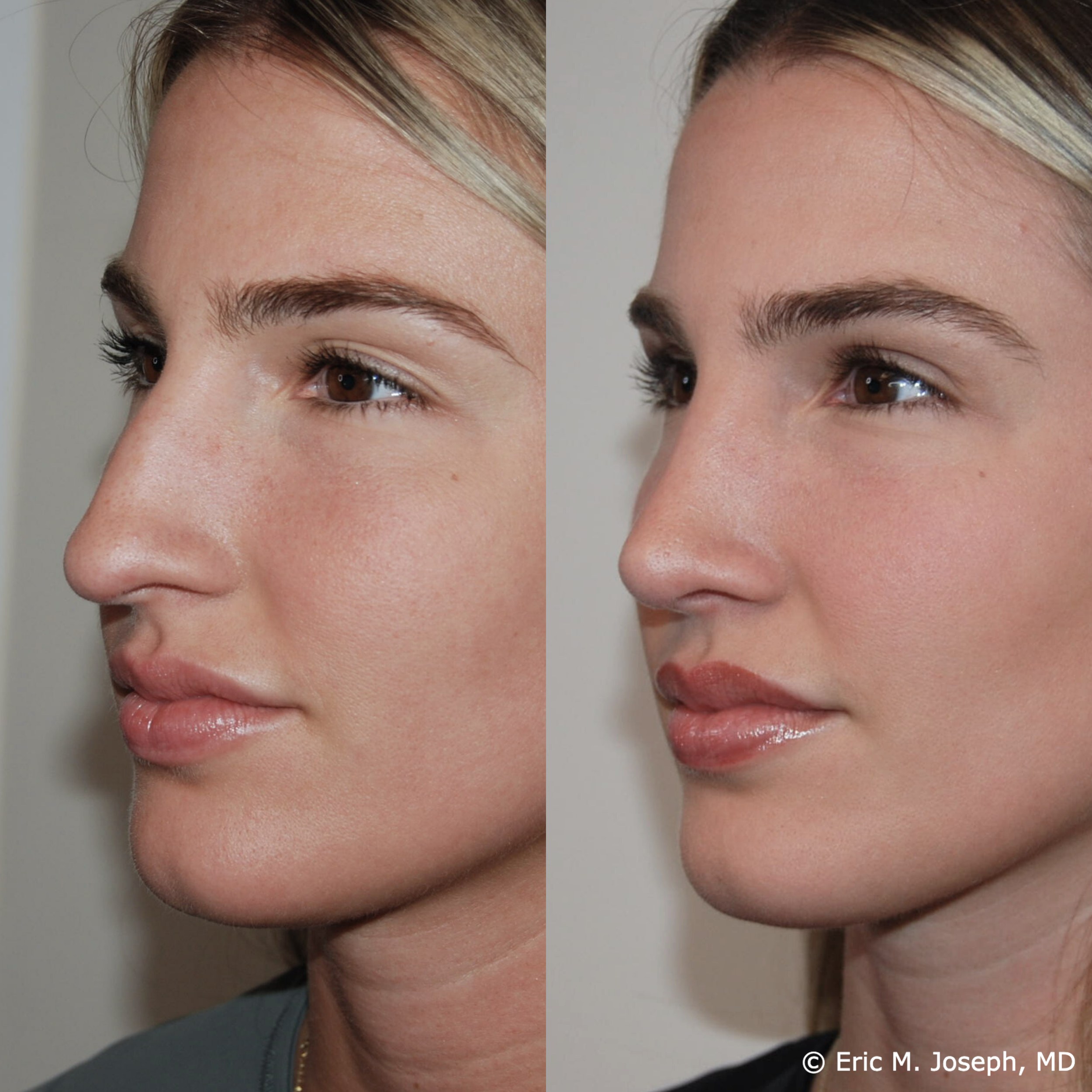 primary-rhinoplasty-nj-1536.png