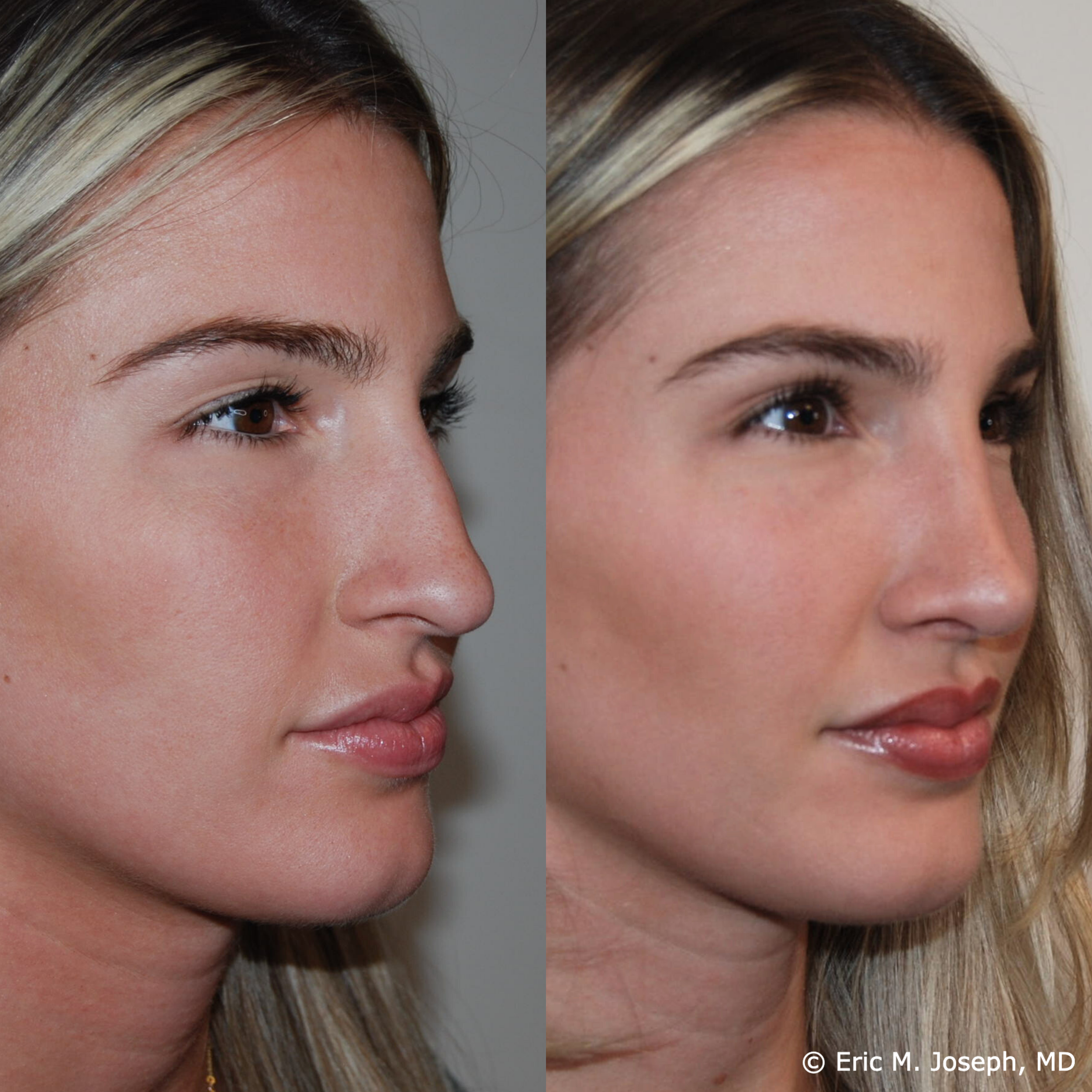 primary-rhinoplasty-nj-1535.png