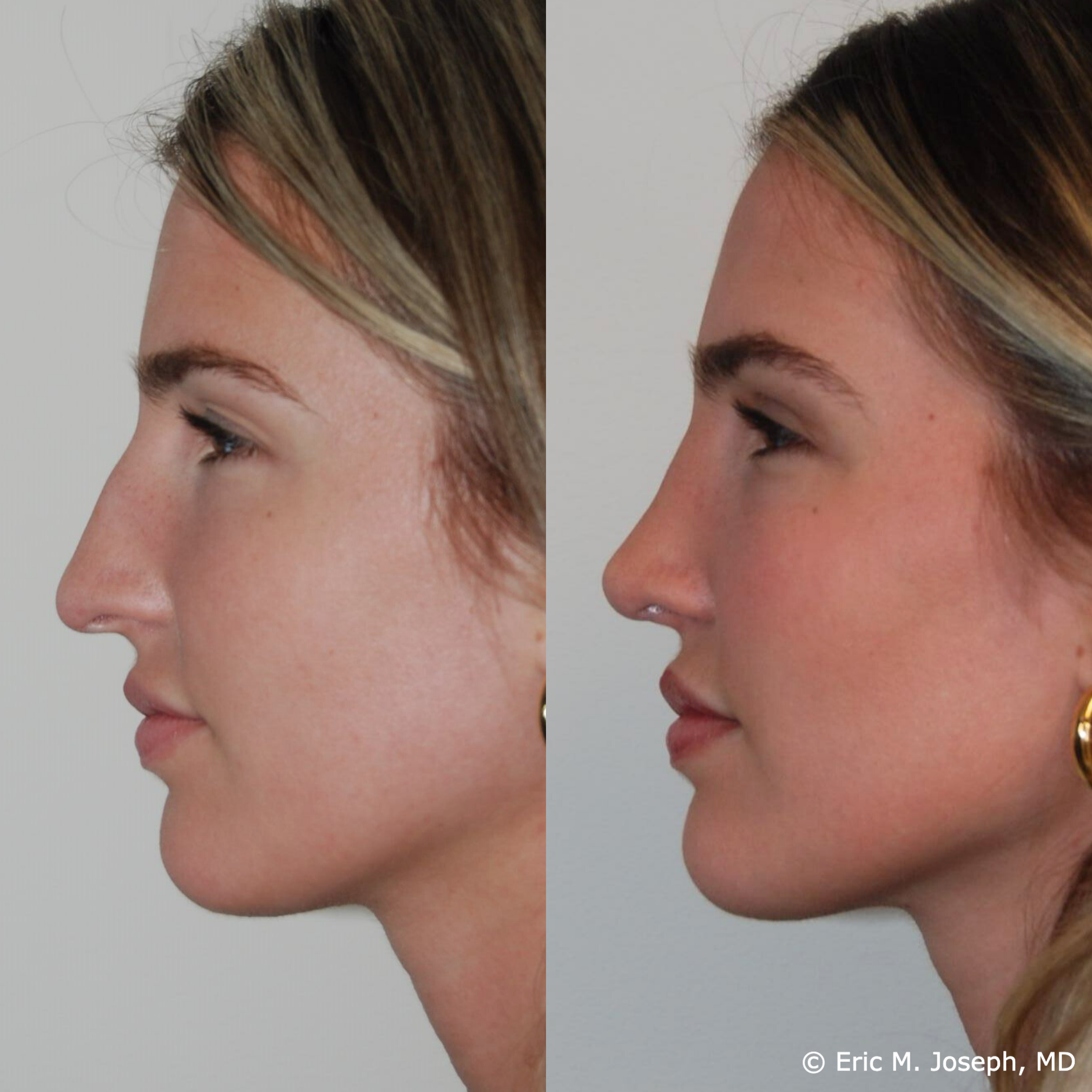 primary-rhinoplasty-nj-1537.png