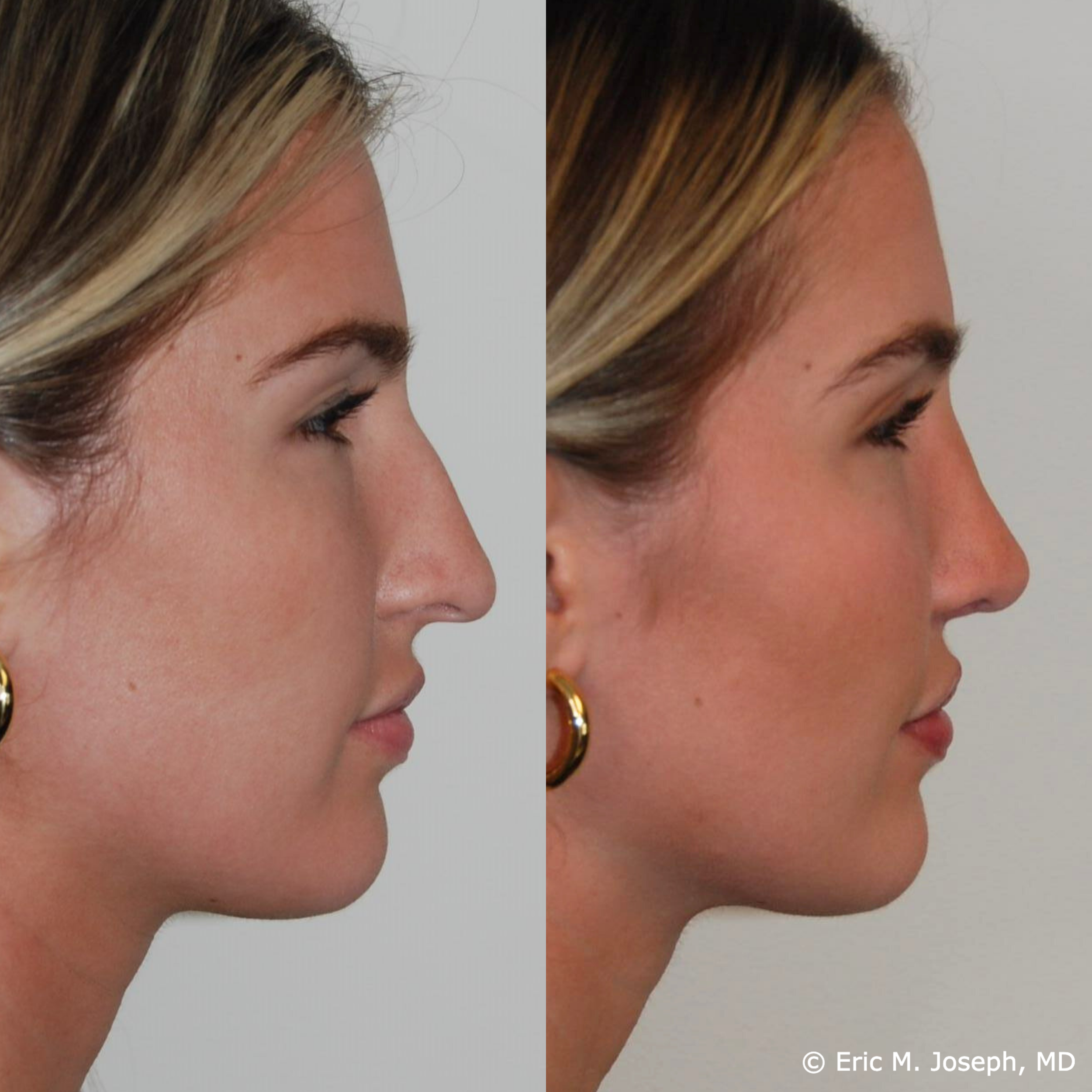 primary-rhinoplasty-nj-1538.png