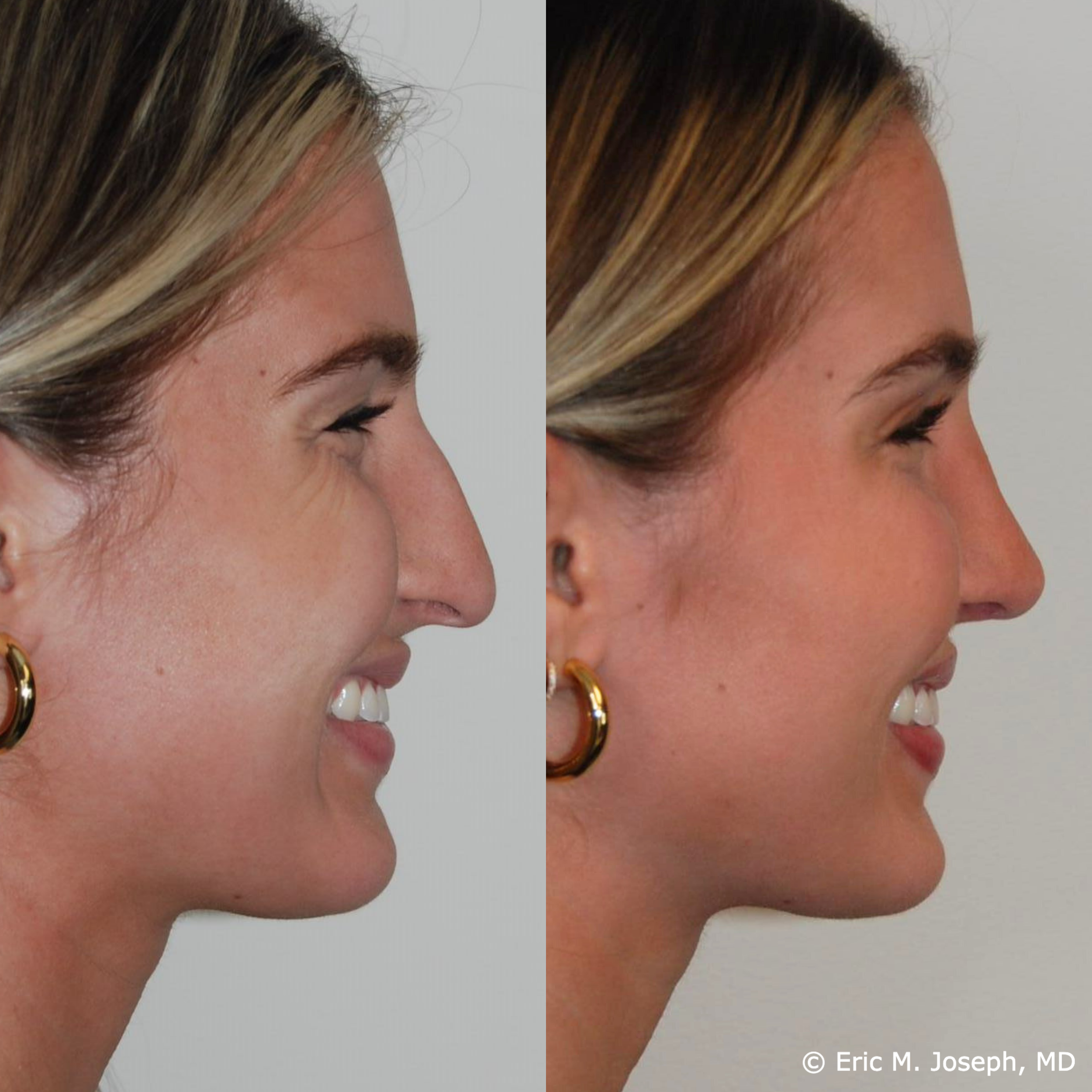 primary-rhinoplasty-nj-1539.png