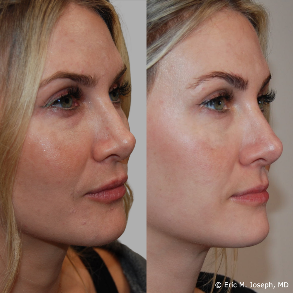 Eric M. Joseph, MD | Non-Surgical Rhinoplasty Before & After