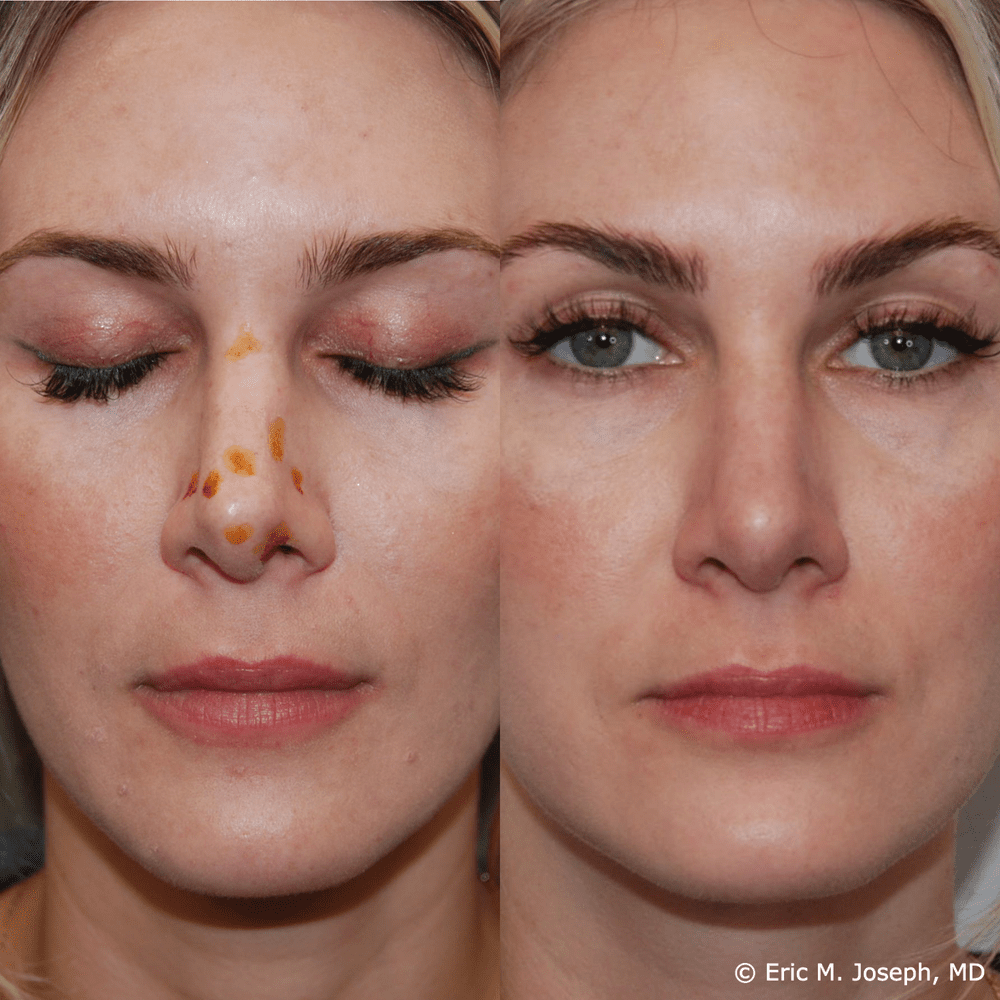 Eric M. Joseph, MD | Non-Surgical Rhinoplasty Before & After