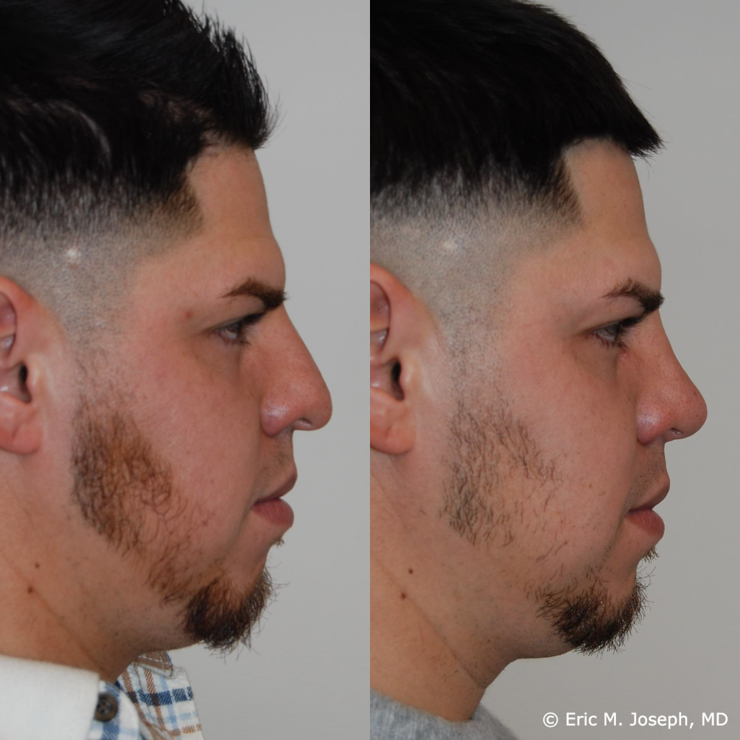 rhinoplasty-specialist-nj-0796.png