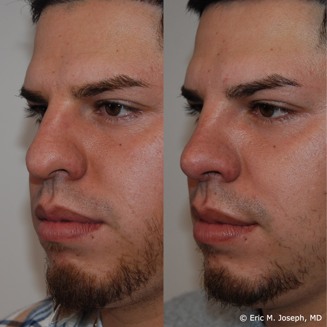 rhinoplasty-specialist-nj-0799.png