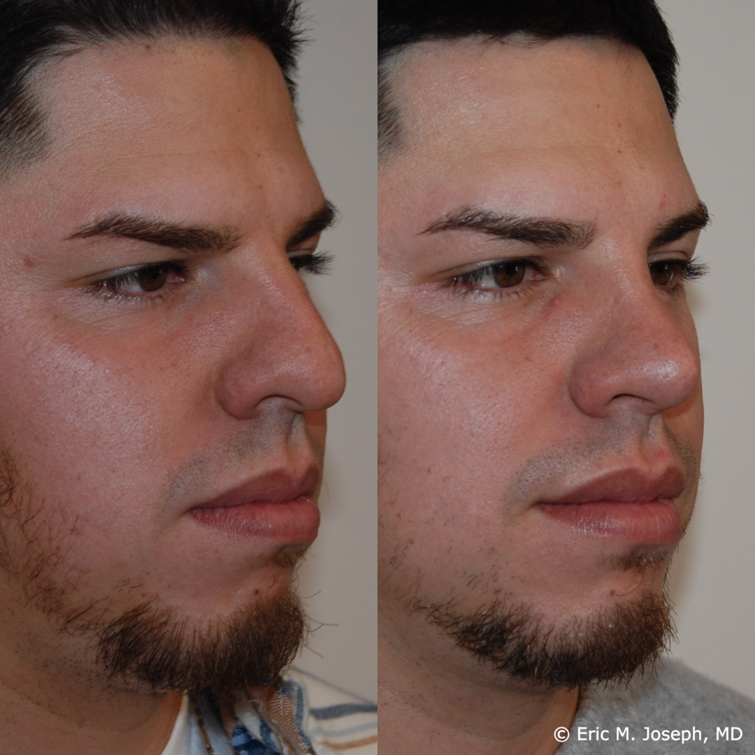 rhinoplasty-specialist-nj-0800.png