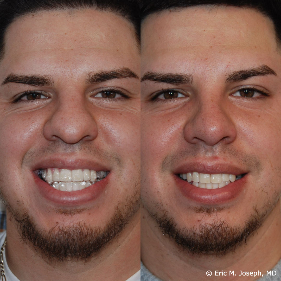 rhinoplasty-specialist-nj-0802.png