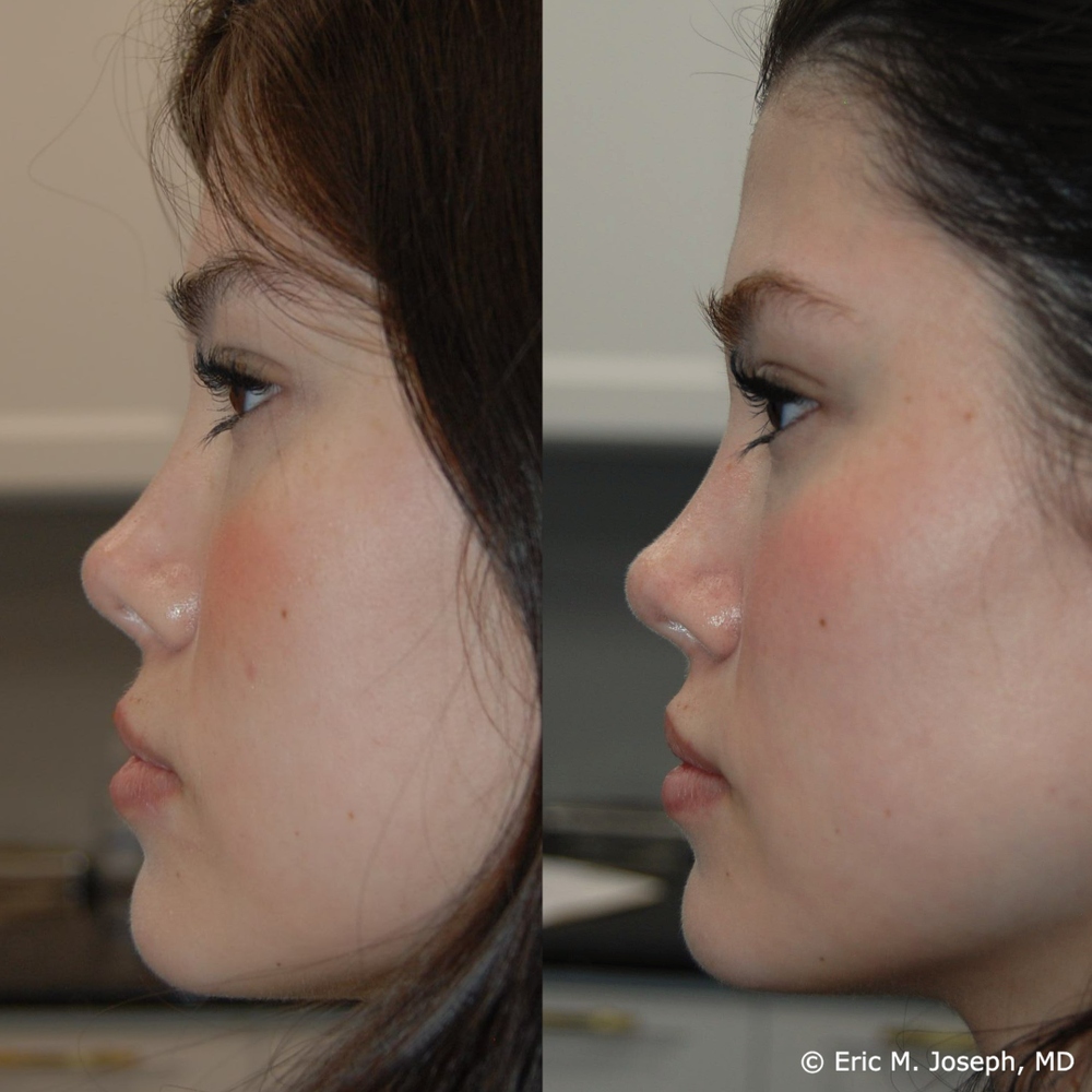 Nose Rhinoplasty 基本技術と臨床ケース Short Nose Rhinoplasty | Nose job | AB Plastic Surgery