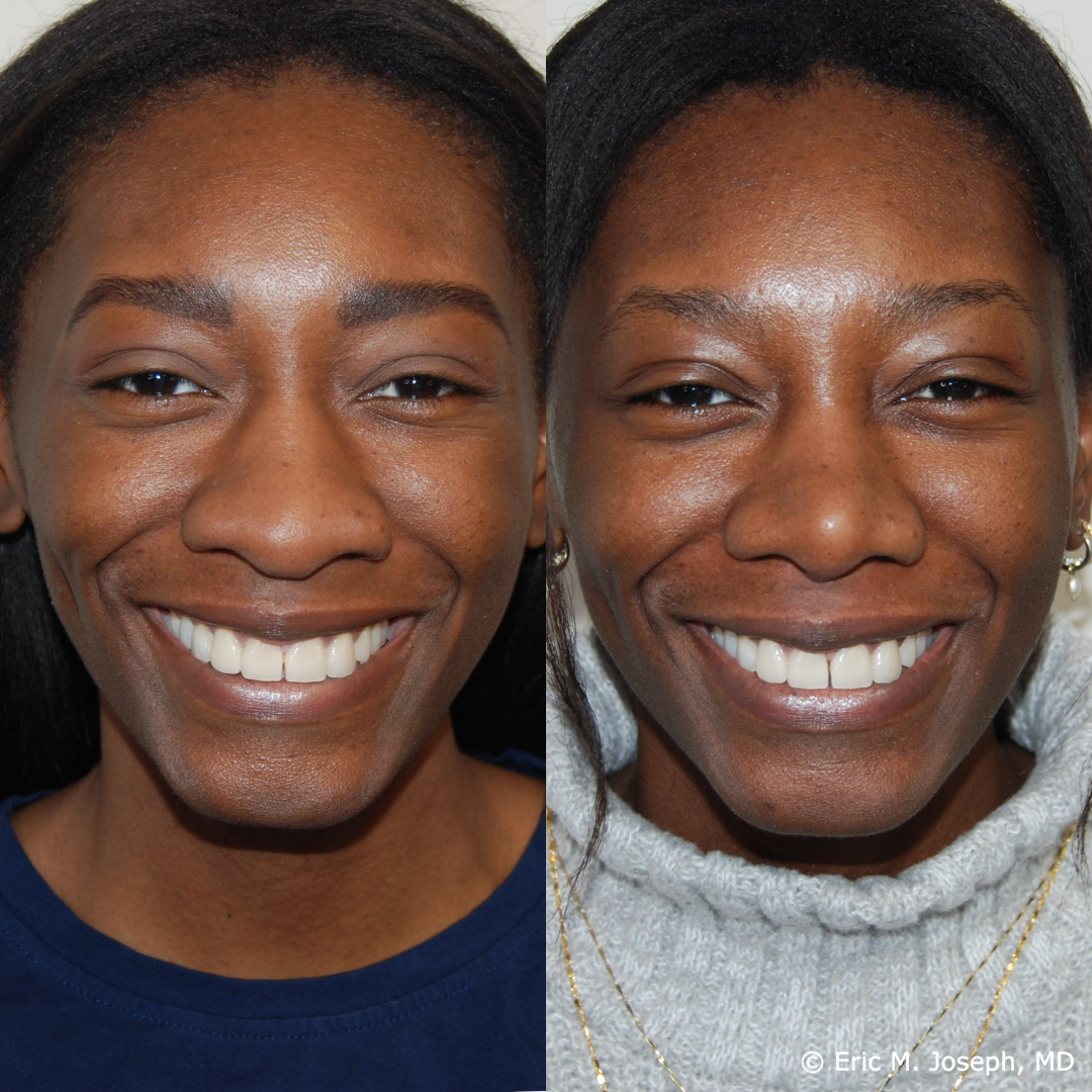 rhinoplasty-specialist-nj-0826.png