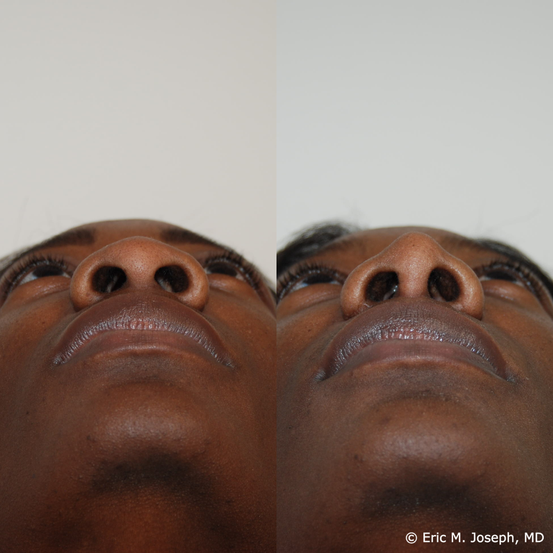 rhinoplasty-specialist-nj-0828.png