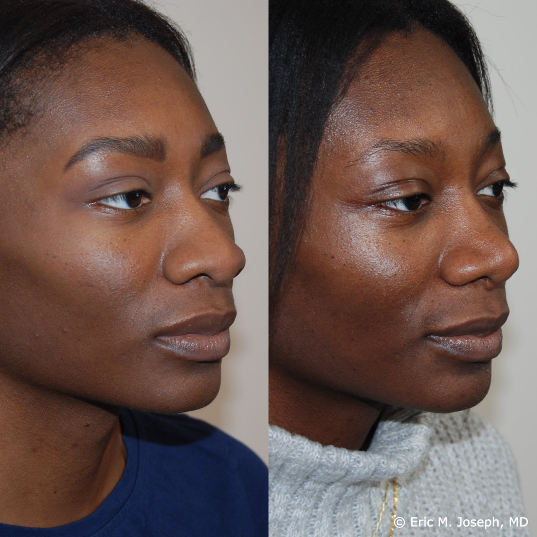 rhinoplasty-specialist-nj-0827.png