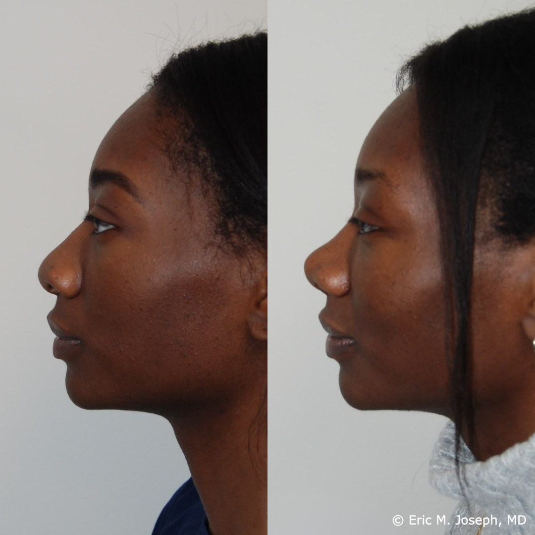 rhinoplasty-specialist-nj-0829.png